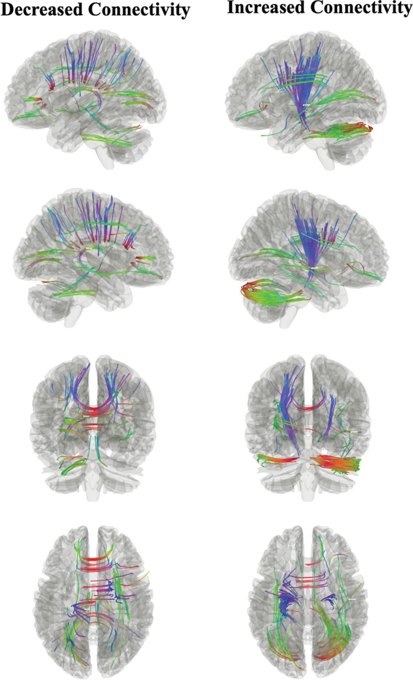 Connectometry analysis examining associations between incident MCI and white matter connectivity. Decreased connectivity (left) was found in the corpus callosum, corticothalamic pathways and cortico-striatal pathway. Increased connectivity (right) was also found in the corticothalamic pathway and cortico-striatal pathway.