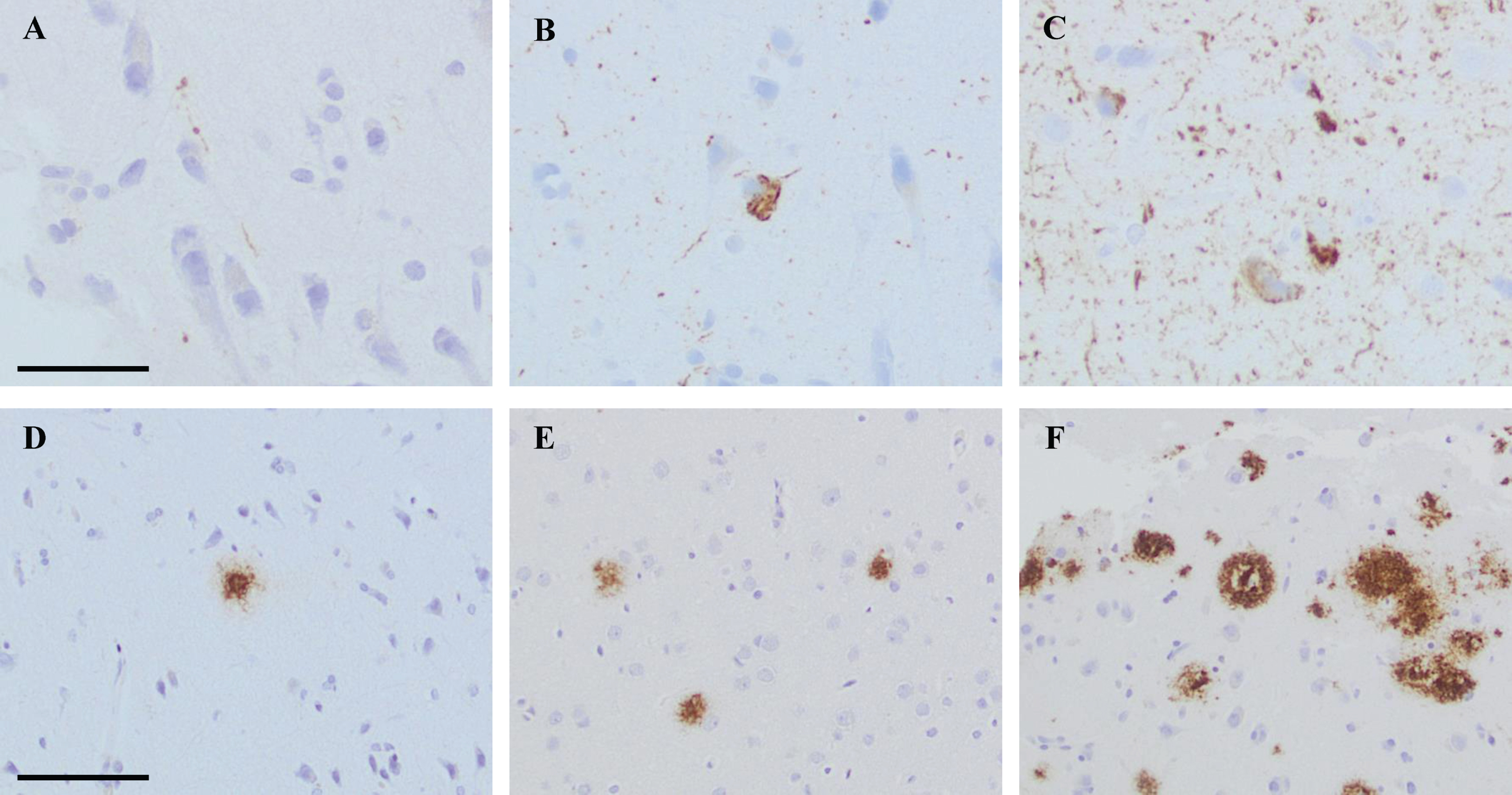 Photos of brain biopsy samples from right frontal cortex, stained by means of immunohistochemistry (IHC). In A-C, IHC outcome at different levels of pathology when applying antibody (Ab) towards hyperphosphorylated tau (HPτ, AT8). In A grade 1 = low level of pathology, in B grade 2 = moderate level of pathology and in C grade 3 = high level of pathology. In D, IHC outcome at grade 1 = low level of pathology when applying Ab towards pyroglutamylated Aβ N3pE. In E and F, IHC outcome at different levels of pathology when applying Ab toward Aβ6F/3D. In E, grade 2 = moderate level of pathology and in F grade 3 = high level of pathology. In A-C, bar 50μm. In D-F bar 100μm.