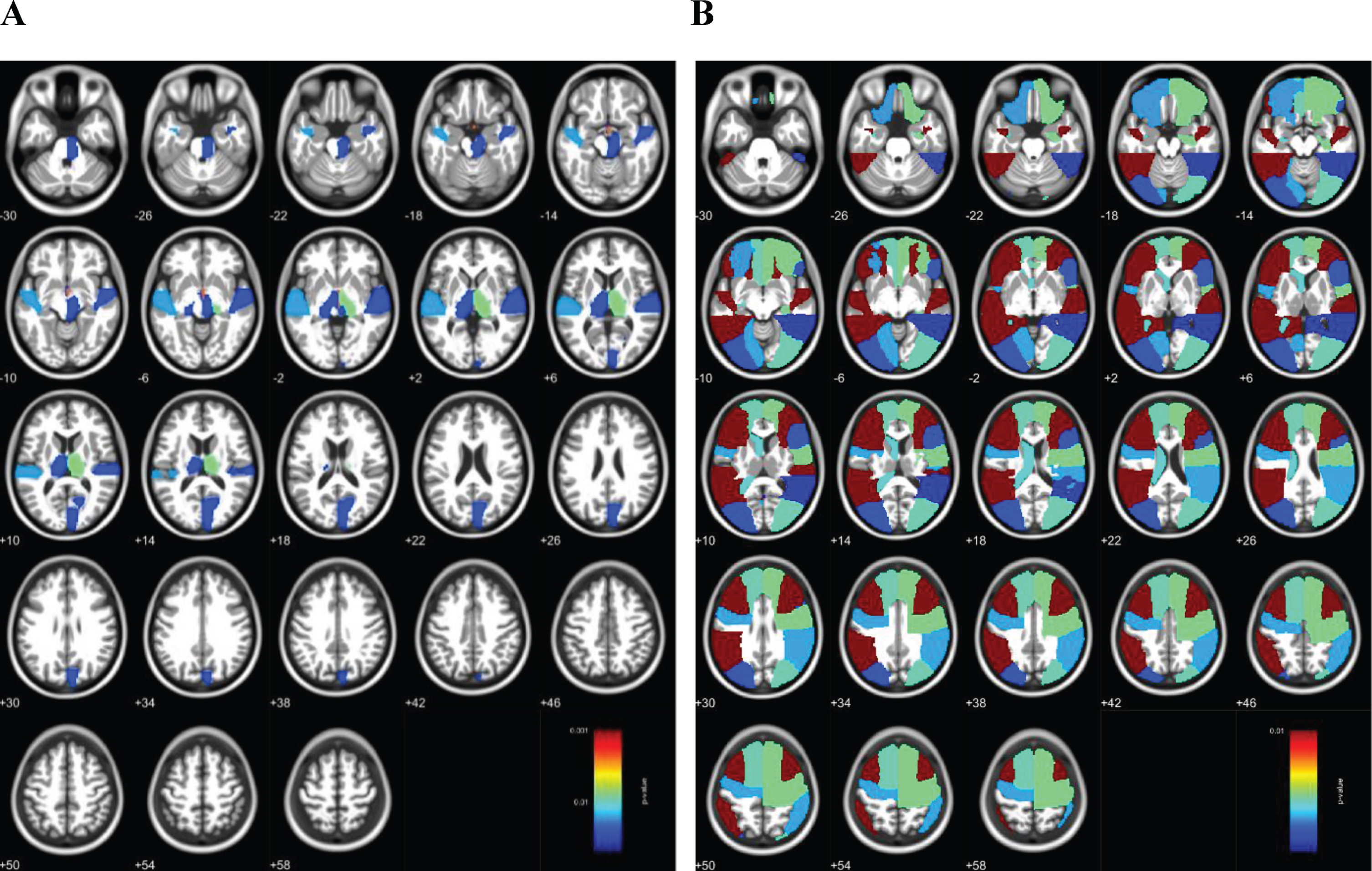 Voxel-wise comparisons of regional grey matter and white matter volumes between people with and without amnestic mild cognitive impairment. Regional volumes were lower in the aMCI group (n = 42) compared with normal controls (n = 138) after controlling for age, sex, education, occupation, ever smoking, alcohol intake, physical exercise, hypertension, diabetes, hyperlipidemia, total intracranial volume, and MRI centers. A) Regional GM volume (e.g., bilateral temporal gyri and thalamus) was reduced in the aMCI group compared with normal controls after FDR correction. B) Regional WM volume (e.g., bilateral frontal and superior temporal areas) was reduced in the aMCI group compared with cognitively normal controls.