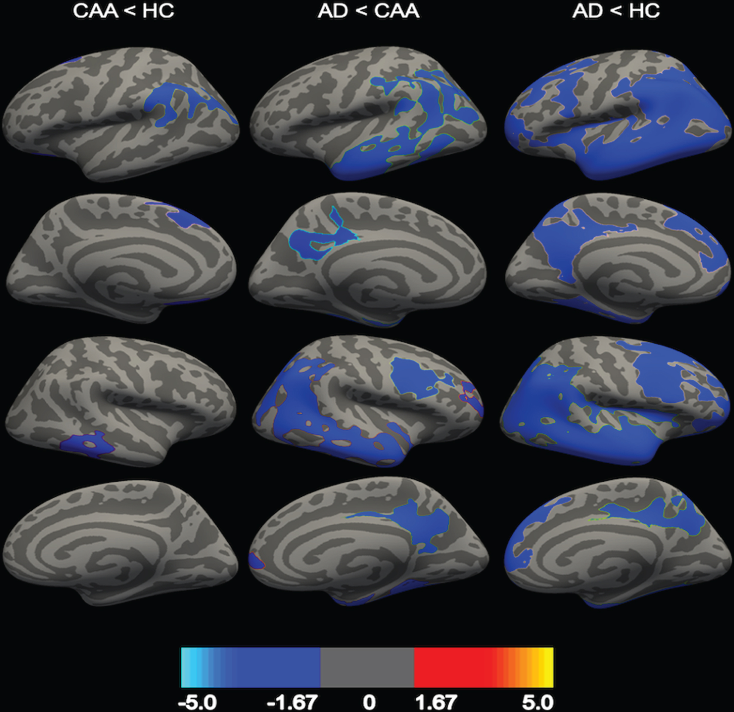 Comparison in regional cortical thickness between AD, CAA, and healthy controls (HC). CAA participants had thinner cortex compared to HC (first column), and AD participants had thinner cortex compared to CAA (second column) and HC (third column). First row = left lateral view, second row = left medial view, third row = right lateral view, fourth row = right medial view. Clusters are represented at a corrected value of p < 0.05, with the color bar showing the logarithmic scale of p-values (-log10).