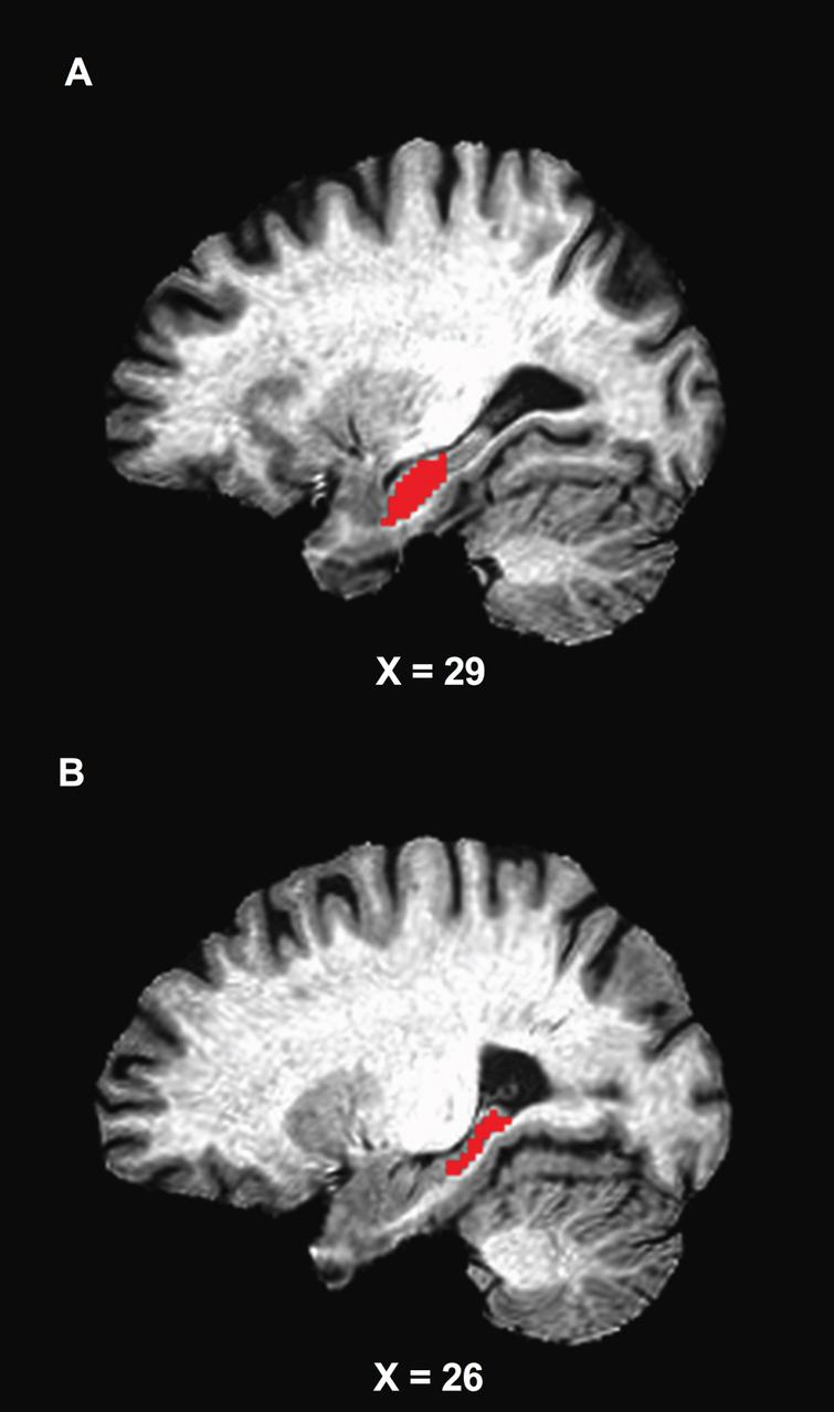 Location of the anterior (A) and posterior (B) seed regions. The seed masks are exhibited on a representative subject’s structural image.