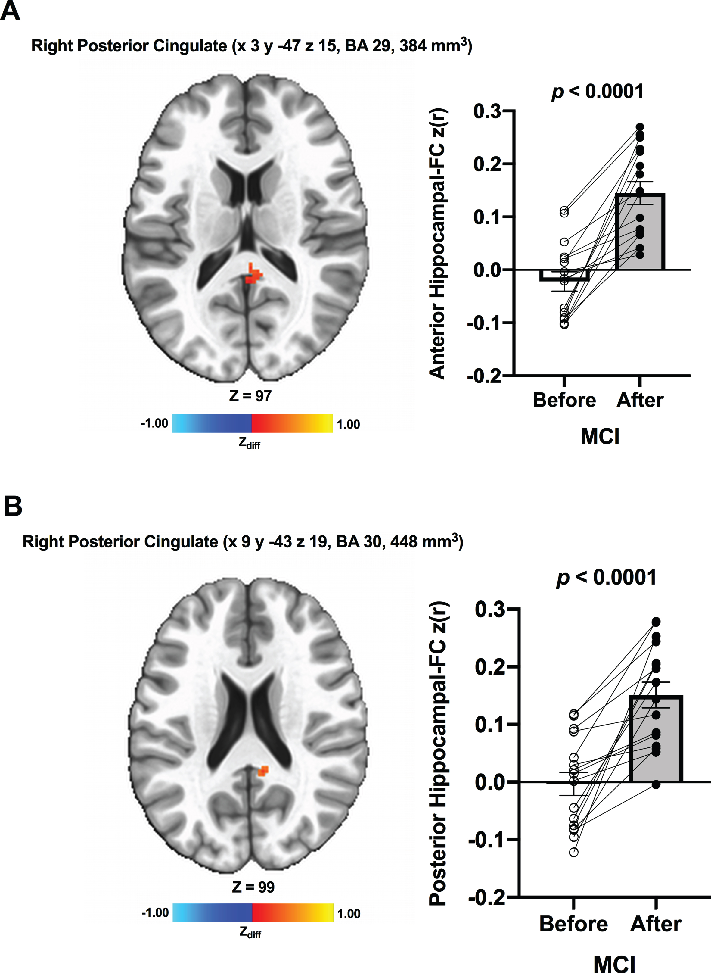Increased functional connectivity between (A) the anterior hippocampal seed and (B) the posterior hippocampal seed and region within the right posterior cingulate, respectively, were found from before to after ET in individuals with MCI. Adjacent bar graphs indicate the connectivity between each hippocampal seed and right posterior cingulate (±SEM) for before and after ET. p-values above bar graphs indicate statistical difference from before to after ET.