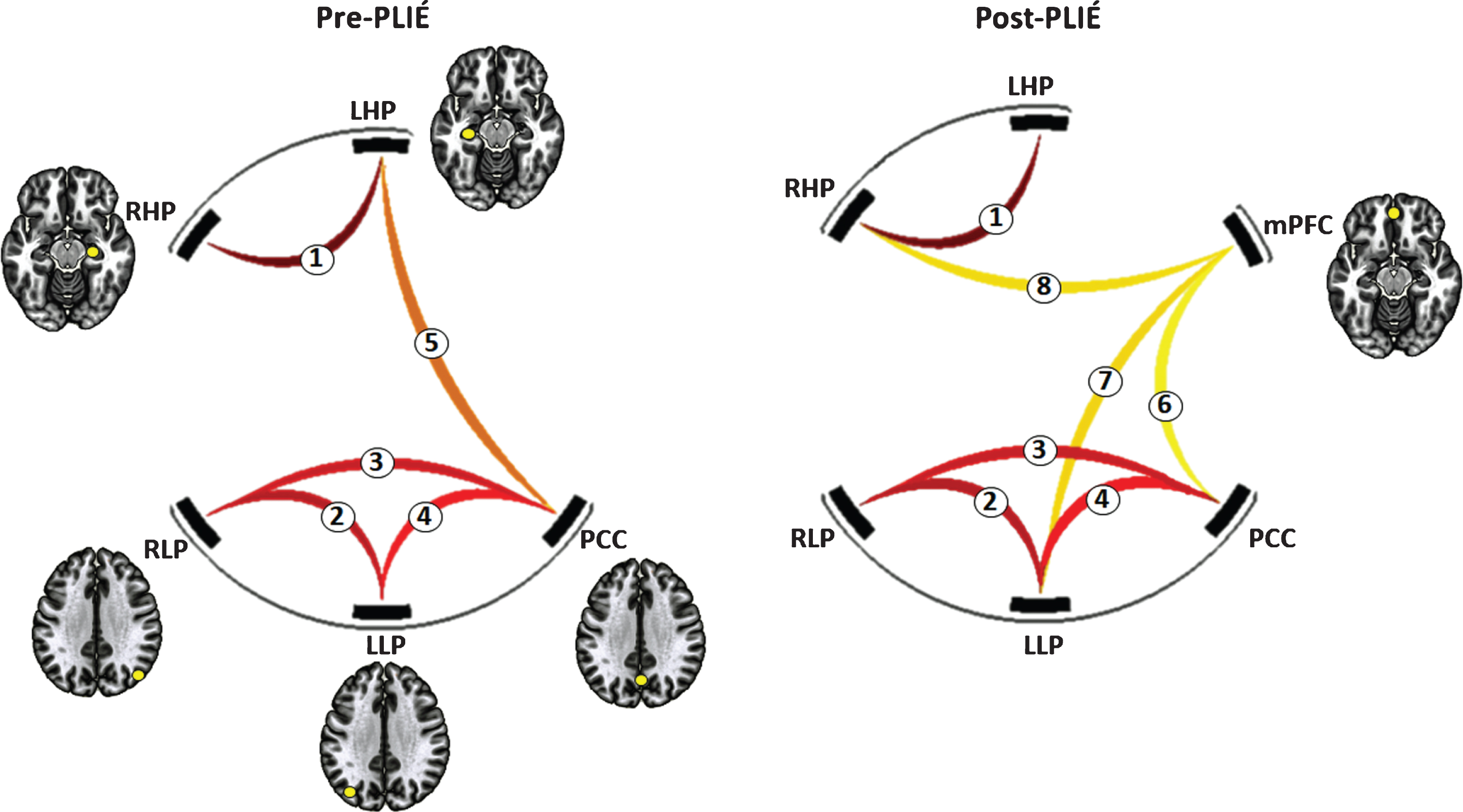 Change in default mode network (DMN) connectivity before and after PLIÉ. The numbers on the connections correspond to numbers denoting the connections in Table 2. RHP, right hippocampus; LHP, left hippocampus; RLP, right lateral parietal; LLP, left lateral parietal; PCC, posterior cingulate cortex; mPFC, medial prefrontal cortex.