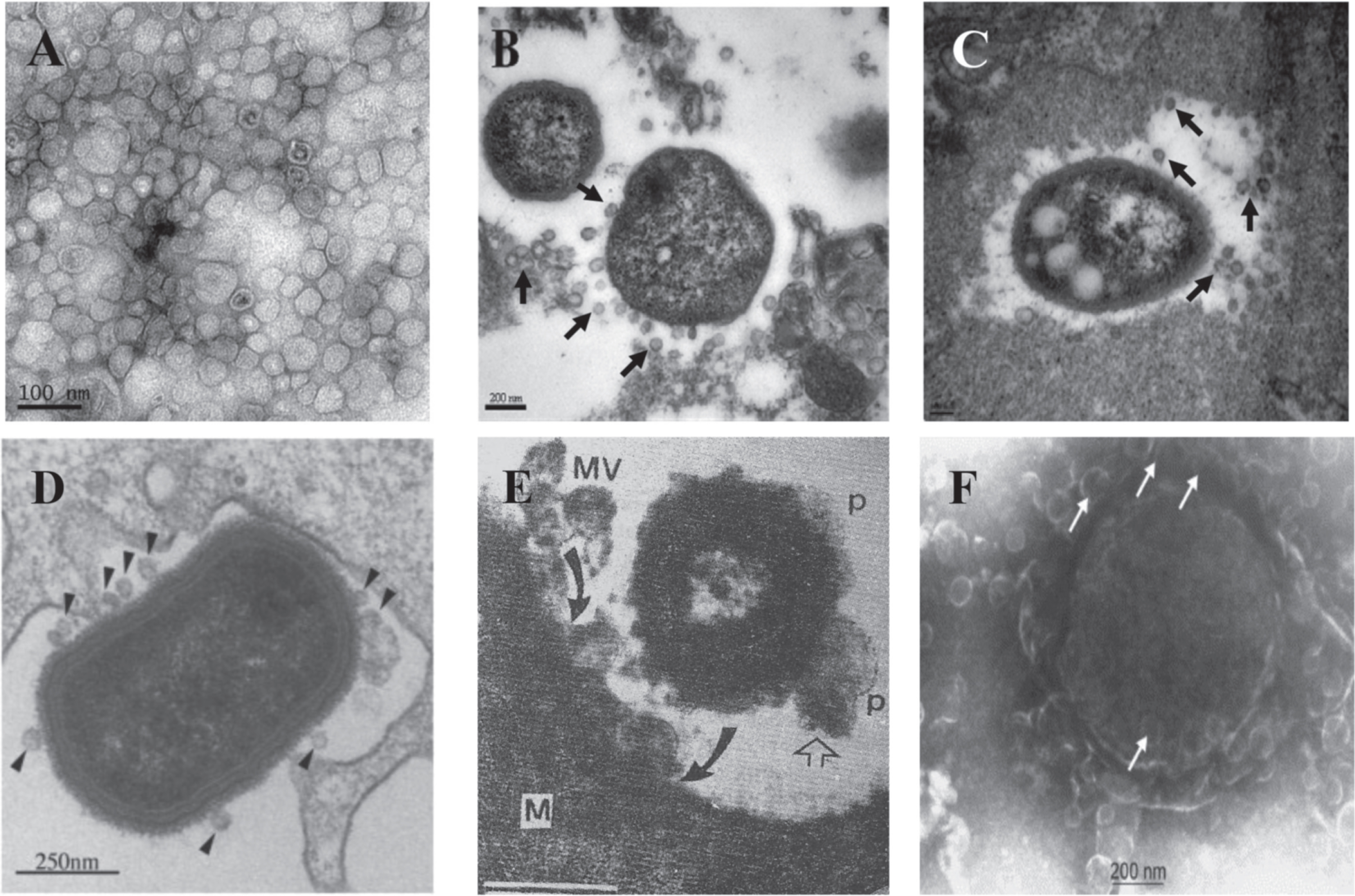 Secretion of OMVs in situ from A. baumanniiduring in vitro culture and in vivo infection. A) Transmission electron micrograph of OMVs prepared from A. baumannii ATCC 19606T cultured in LB broth for 24 h. B, C) Secretion of OMVs from A. baumannii ATCC 19606T in a murine pneumonia model. Mice were infected with 16107 CFU of bacteria intratracheally and sacrificed 48 h after bacterial injection. Arrows indicate the OMVs secreted from A. baumannii. D) TEM image of P. gingivalis entering human epithelial cell and producing numerous OMVs (arrowheads). E) TEM of human Salmonella organism bearing periplasmic organelles (p, line arrow) on its surface and releasing bacterial outer membrane vesicles (MV) being endocytosed (curved arrow) by macrophage cell (M) in chicken ileum in vivo. F) Meningococcus cell in plasma of acute meningitis patient showing blebbing of numerous outer membrane vesicles with a blood level of LPS of 1700 endotoxin units/mL or approx. 170 ng/ml of purified E. coli LPS (65,000X mag.) Panels A-C are reprinted with permission from Jin JS, Kwon SO, Moon DC, Gurung M, Lee JH, Kim SI, Lee JC (2011) Acinetobacter baumannii secretes cytotoxic outer membrane protein A via outer membrane vesicles. PLoS One 6, e17027, under the Creative Commons Attribution License. Panel D is reprinted from Amano A, Takeuchi H, Furuta N (2010) Outer membrane vesicles function as offensive weapons in host-parasite interactions. Microbes Infect 12, 791–798, with permission Elsevier. Panel E is reprinted from Wikiwant (https://www.wikiwand.com/en/Membrane_vesicle_trafficking) under the Creative Commons Attribution-ShareAlike 4.0 International License (CC BY-SA). Panel F is reprinted from Namork E, Brandtzaeg P (2002) Fatal meningococcal septicaemia with “blebbing” meningococcus. Lancet 360, 1741, with permission from Elsevier.