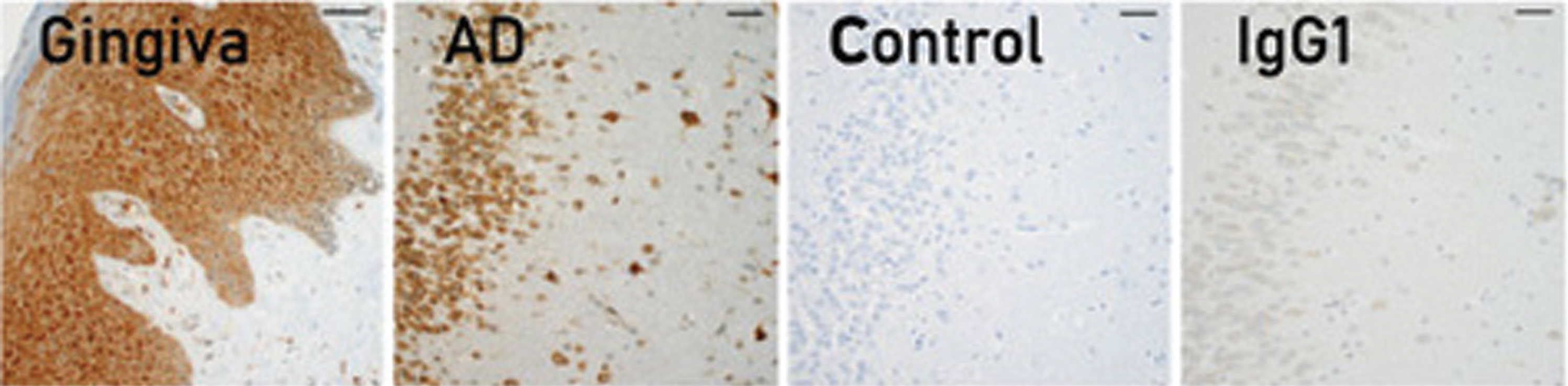 Immunohistochemical localization of gingipains in human gum tissues, AD brain tissues. Adapted with permission from Dominy SS, Lynch C, Ermini F, et al. (2019) Porphyromonas gingivalis in Alzheimer’s disease brains: Evidence for disease causation and treatment with small-molecule inhibitors. Sci Adv 5, eaau3333, under the Creative Commons Attribution license (CC BY 4.0).