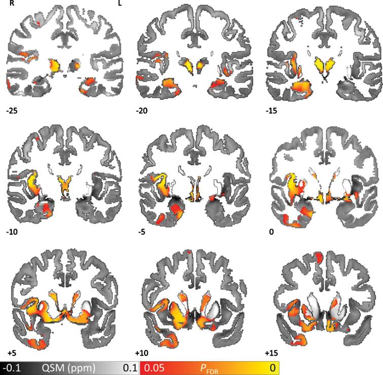 QSM covarying with lower cognitive performance (MoCA) reveals increased brain tissue iron in hippocampus, thalamus, putamen and caudate nucleus in Parkinson’s disease. Whole brain results are overlaid onto the study-wise QSM template in the MNI coordinate system. Red/yellow clusters represent statistical significance at PFDR < 0.05 as indicated by the color bar. Numbers represent slice position in millimeters in MNI coordinate space. FDR, false discovery rate; MNI, Montreal Neurological Institute; MoCA, Montreal Cognitive Assessment; QSM, quantitative susceptibility mapping. Reprinted with permission from Thomas GEC, Leyland LA, Schrag AE, Lees AJ, Acosta-Cabronero J, Weil RS (2020) Brain iron deposition is linked with cognitive severity in Parkinson’s disease. J Neurol Neurosurg Psychiatry 91, 418–425, under the Creative Commons Attribution 4.0 Unported (CC BY 4.0) license.