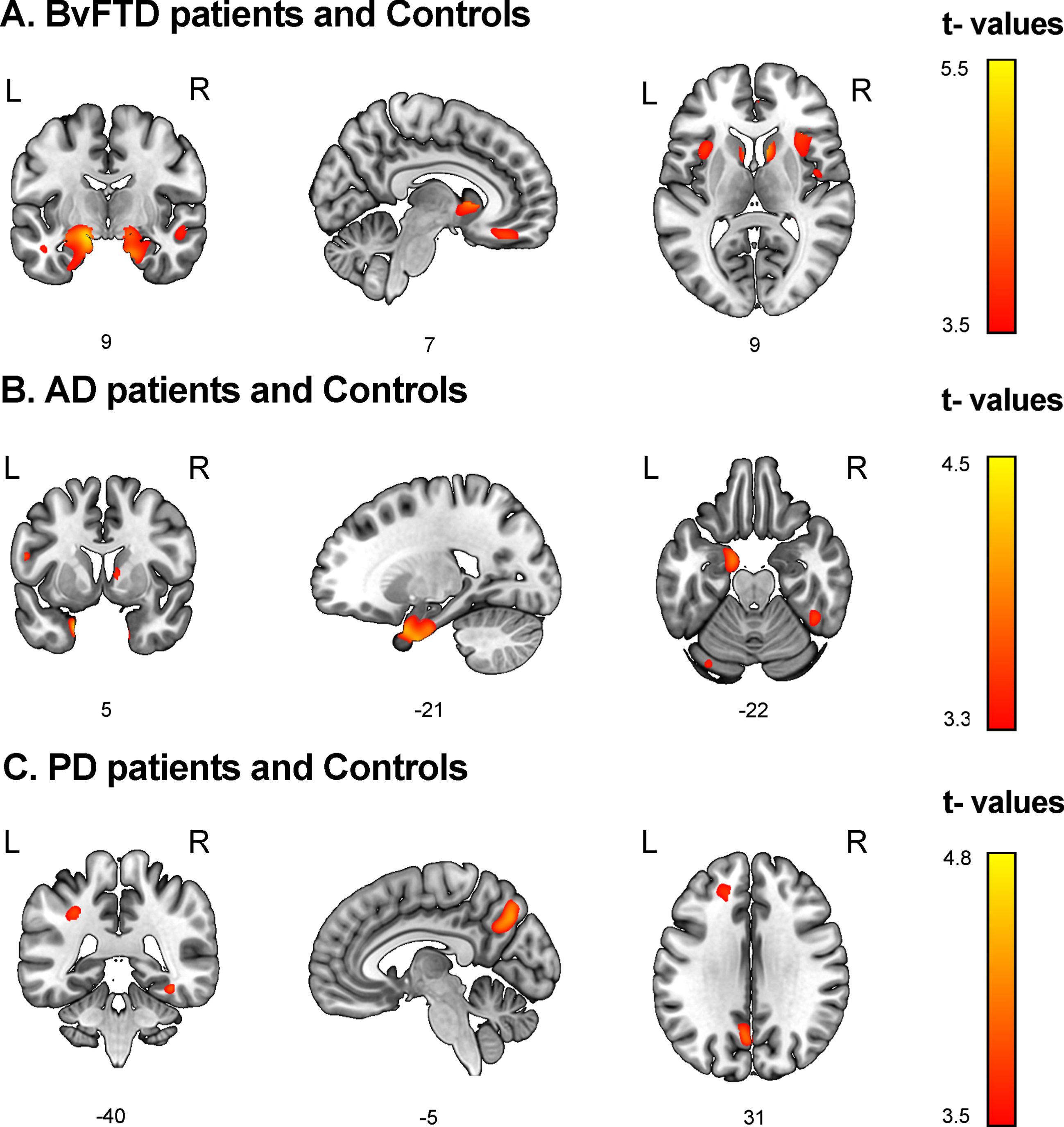 Associations between discriminant scores and gray matter volume. Voxel-based morphometry was conducted to identify brain regions associated with top discriminant scores in each patient group in tandem with demographically-matched controls (p < 0.001 uncorrected, extent threshold = 30 voxels). A) BvFTD patients and controls. Social cognition and CS (MiniSEA and MoCA) were associated with frontal (gyrus rectus, superior frontal gyrus), temporal (the superior, middle, and inferior temporal gyri, fusiform gyrus, hippocampus, and parahippocampal gyrus), parietal (postcentral gyrus), and insular regions as well as the basal ganglia. B) AD patients and controls. CS (MoCA) results were associated with temporal (hippocampus, amygdala, parahippocampal gyrus, superior temporal, and fusiform gyri), frontal (superior frontal gyrus), and parietal (postcentral gyrus) regions. C) PD patients and controls. Social cognition (MiniSEA) outcomes were associated with parietal (inferior parietal lobule and precuneus), frontal (frontal superior gyrus and anterior cingulate cortex), and temporal (superior temporal and fusiform gyri) regions. AD: Alzheimer’s disease; bvFTD: behavioral variant frontotemporal dementia; L, left; PD, Parkinson’s disease; R, right.