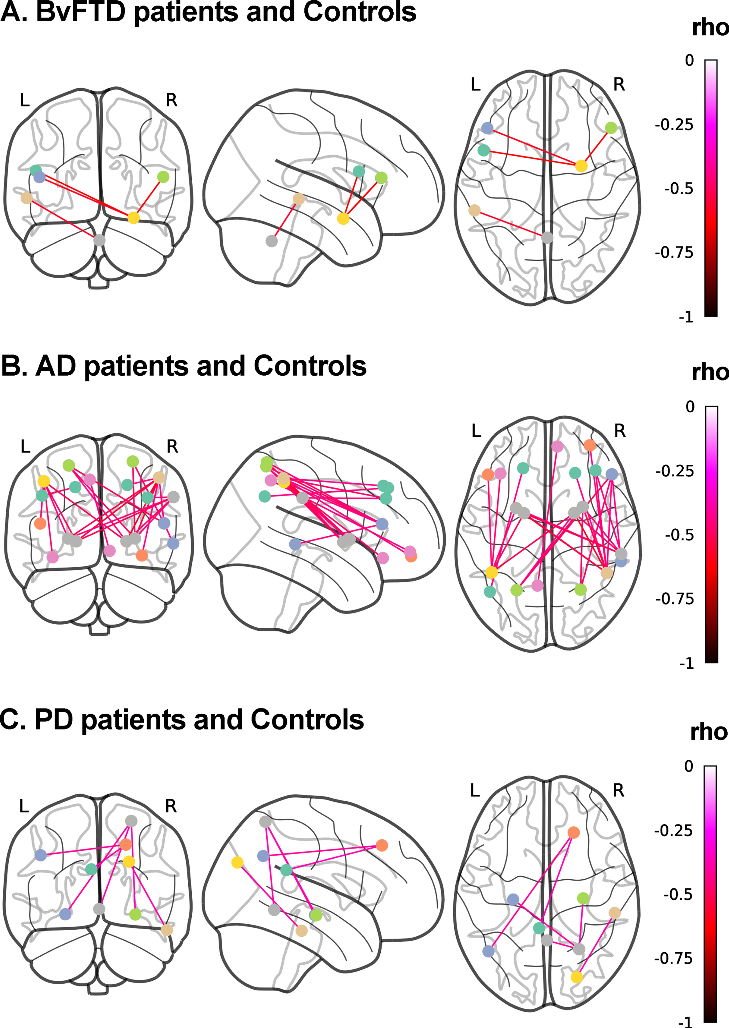 Associations between discriminant scores and functional connectivity. Whole-brain analyses over 116 regions of interest from the AAL atlas were performed to test the association between the FC of each pair of brain areas and top discriminant scores in each patient group in tandem with demographically-matched controls (p < 0.001, uncorrected). A) BvFTD patients and controls. Social cognition and CS (MiniSEA and MoCA) outcomes were associated with frontal (inferior frontal gyri/pars triangularis and pars opercularis) and amygdalar networks. B) AD patients and controls. CS (MoCA) results were associated with (a) parietal (parietal superior and inferior lobules, and precuneus and angular gyrus) and frontal (inferior frontal gyrus triangular and orbital, and frontal superior and middle gyri), and (b) parietal superior and inferior lobules, supramarginal gyrus) and basal ganglia (pallidum and putamen) networks. C) PD patients and controls. Social cognition (MiniSEA) results were associated with (a) parietal (parietal superior lobule), temporal (hippocampi) and cerebellar networks, (b) frontal (superior frontal gyrus) and pariental (angular gryus and posterior cingulate) networks, and (c) temporal (inferior temporal gyrus) and occipital (superior occipital gyrus) networks. AD, Alzheimer’s disease; bvFTD, behavioral variant frontotemporal dementia; L, left; PD, Parkinson’s disease; R, right.