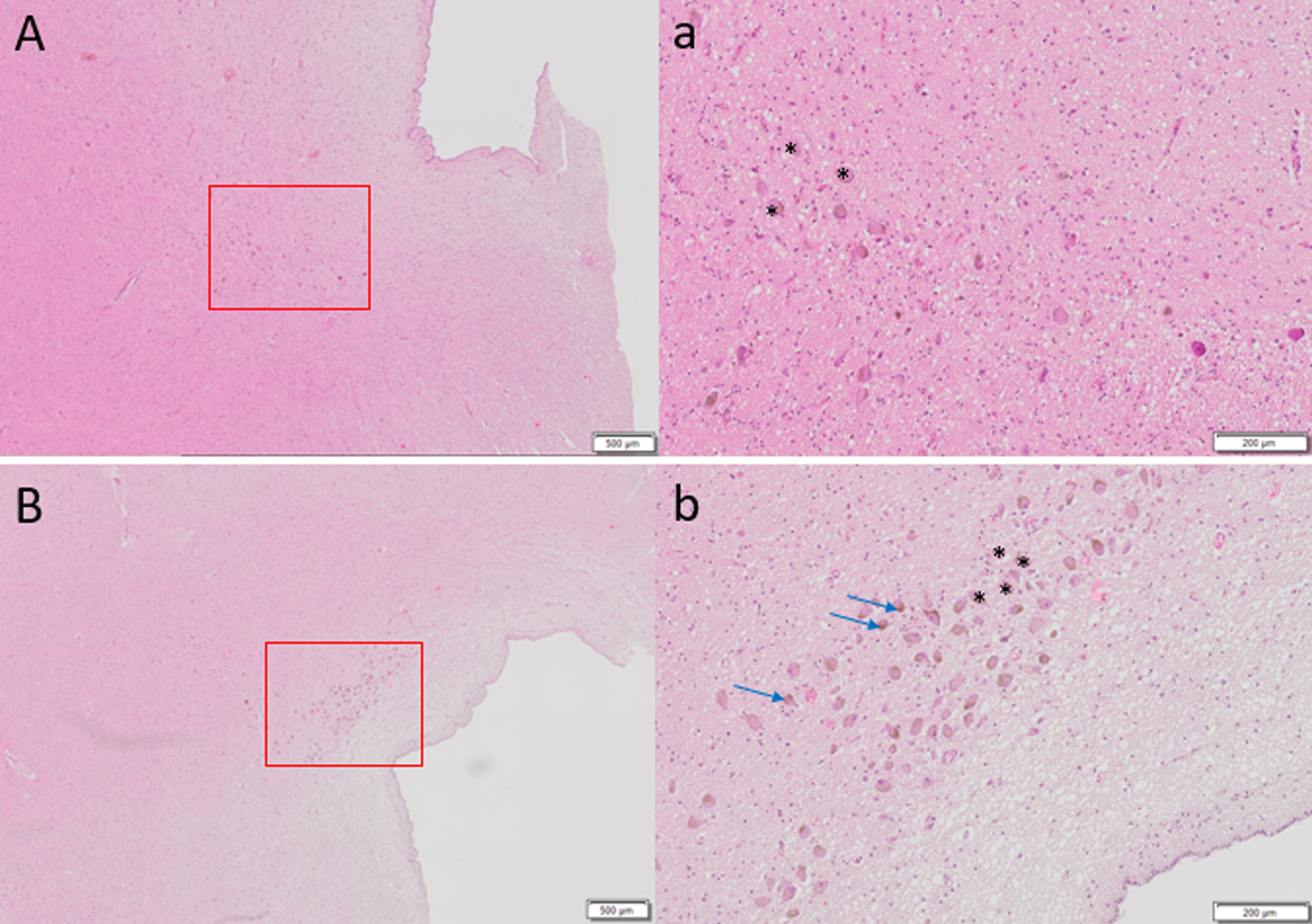 Hematoxylin and eosin staining of 6μm thick axial sections of pons to show locus coeruleus cells (denoted by *) of A) 87-year-old female with Alzheimer’s disease diagnosis at death, Braak stage 6 compared to control brain of B) 86-year-old female, Braak stage I. Far fewer LC cells are observed in A. Brown pigmented neuromelanin granules can be seen (blue arrows). Scale bar A, B = 500μm, scale bar a, b = 200μm.