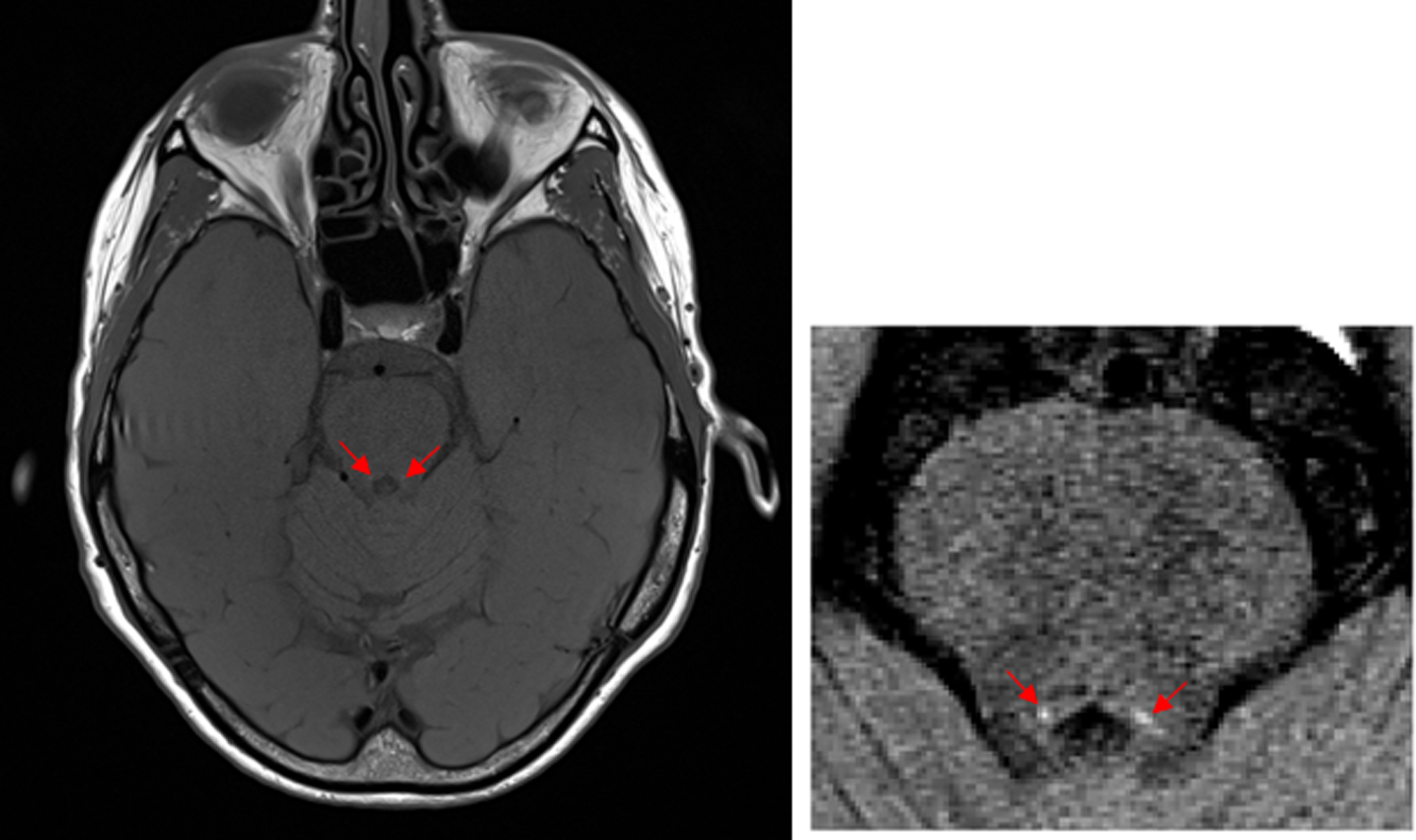 NM-MR axial image of a 69 year old female with no cognitive impairment obtained on 3Tesla Siemens Skyra MRI scanner at the level approximately 7mm below the inferior colliculi, in which the LC can be observed as two hyperintense areas (red arrows) [184].
