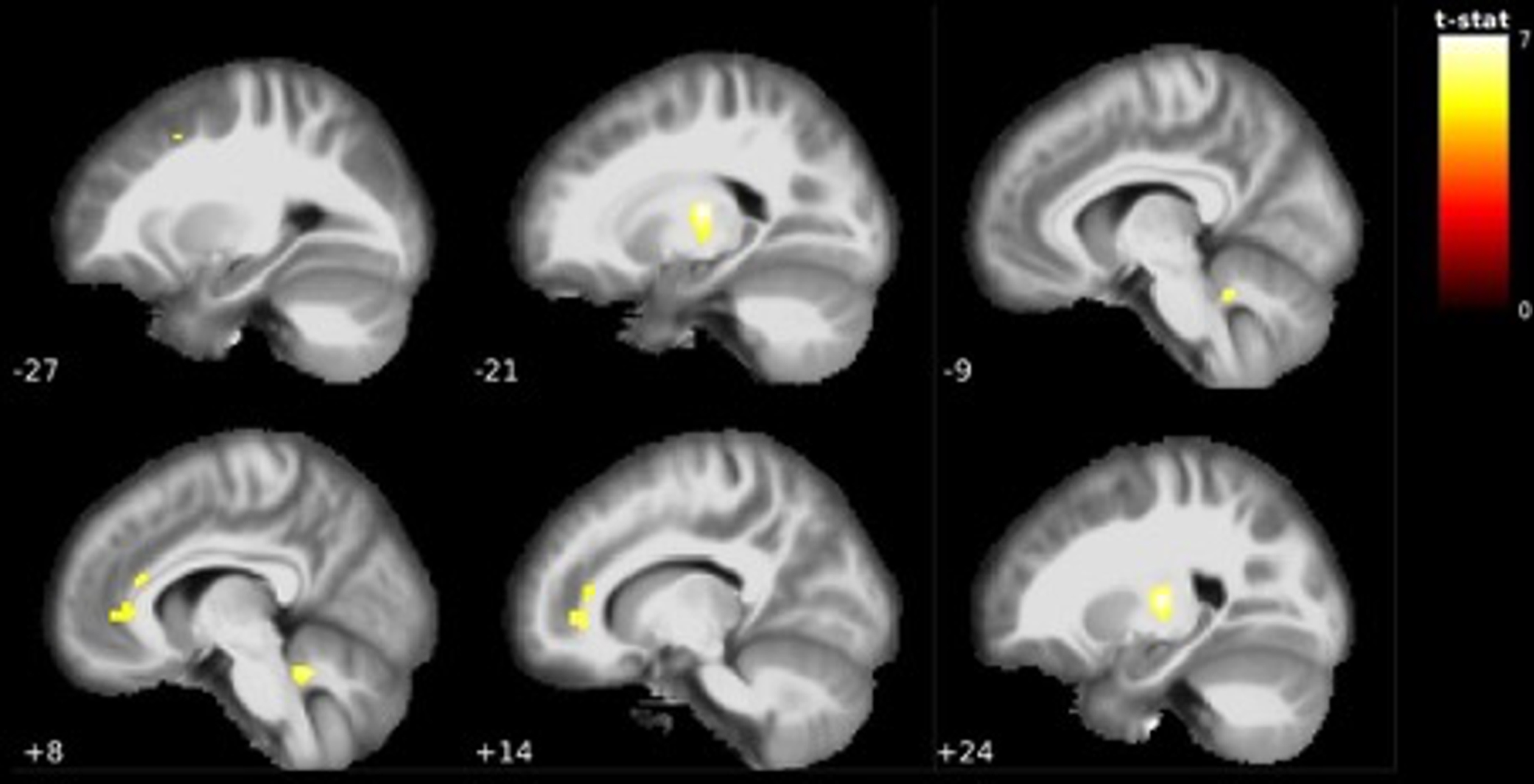 Visualization of grey matter volume reductions in EMCI < CN. Reductions centered around the bilateral ventrolateral thalamus, orbitofrontal cortex, anterior cingulate cortex and cerebellum. MNI coordinate along the x-axis indicated in white. Lighter colors indicate higher t-values (see Table 2).