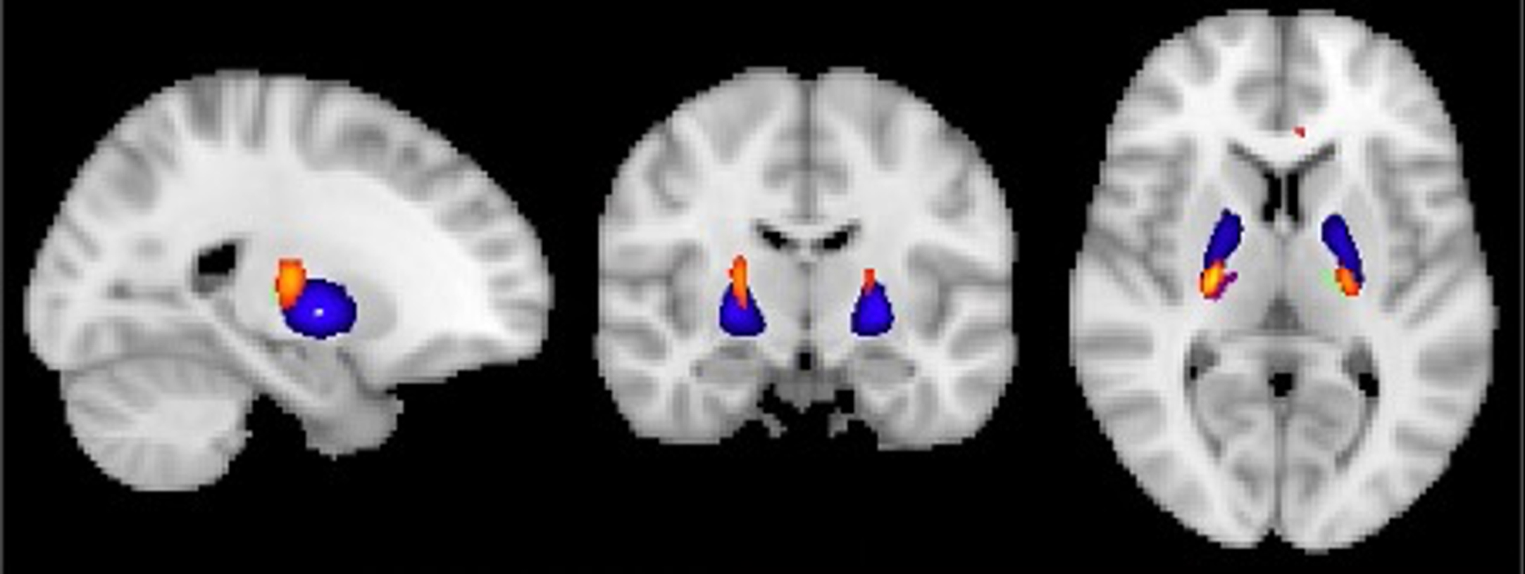 Visualization of GM volume reduction cluster (yellow/orange) in EMCI < CN located in the bilateral ventrolateral thalamus (green/purple) and globus pallidus (blue) according to the Talairach and Harvard-Oxford structural atlas.