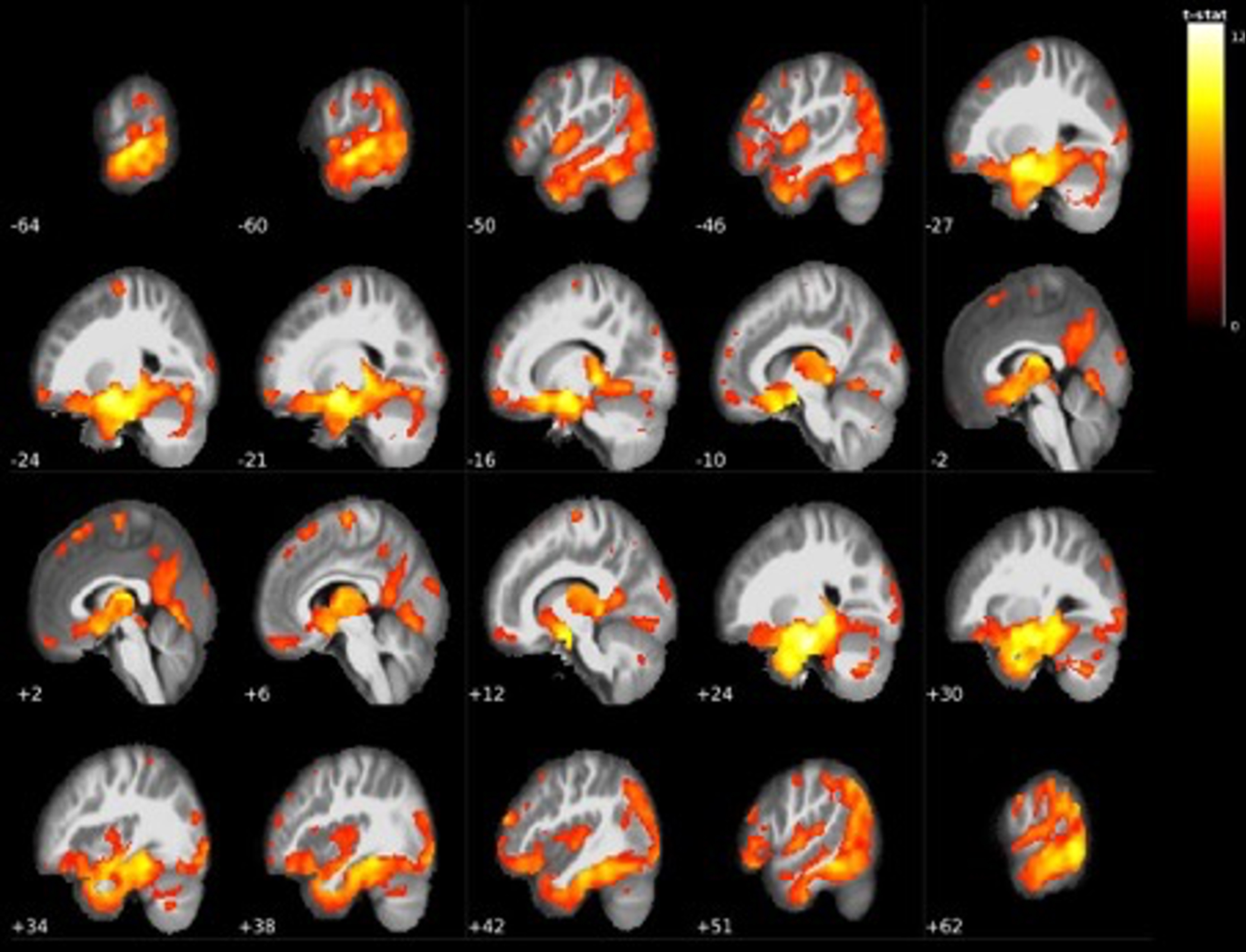Widespread grey matter volume reductions in LMCI < EMCI. The largest cluster centered around the bilateral mediotemporal gyri, hippocampus, and entire thalamus (see Table 3).