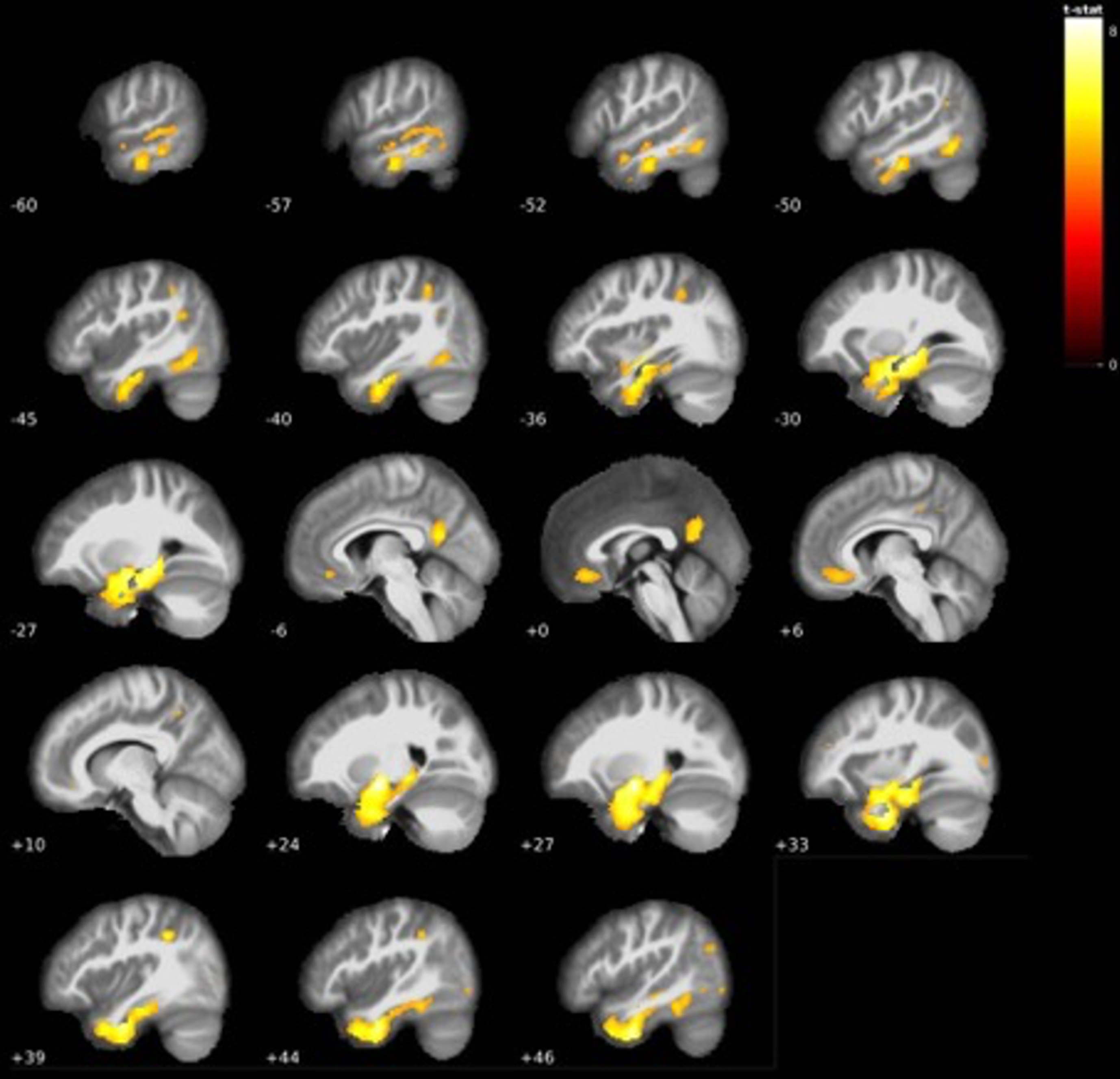 Additional grey matter volume reductions centered mostly around temporal areas in AD dementia < LMCI (see Table 4).
