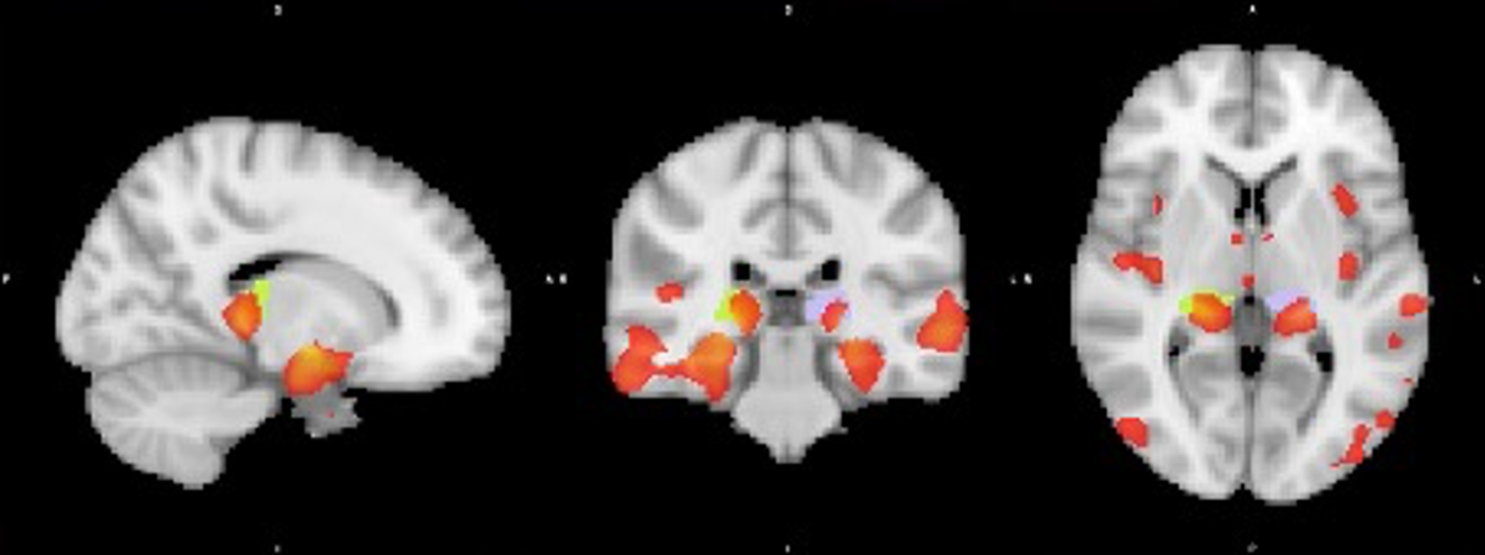 Visualization of GM volume reduction cluster (red) in AD dementia converters located in the bilateral hippocampus and left (purple) and right (yellow) posterior thalamus/pulvinar according to the Talairach structural atlas.