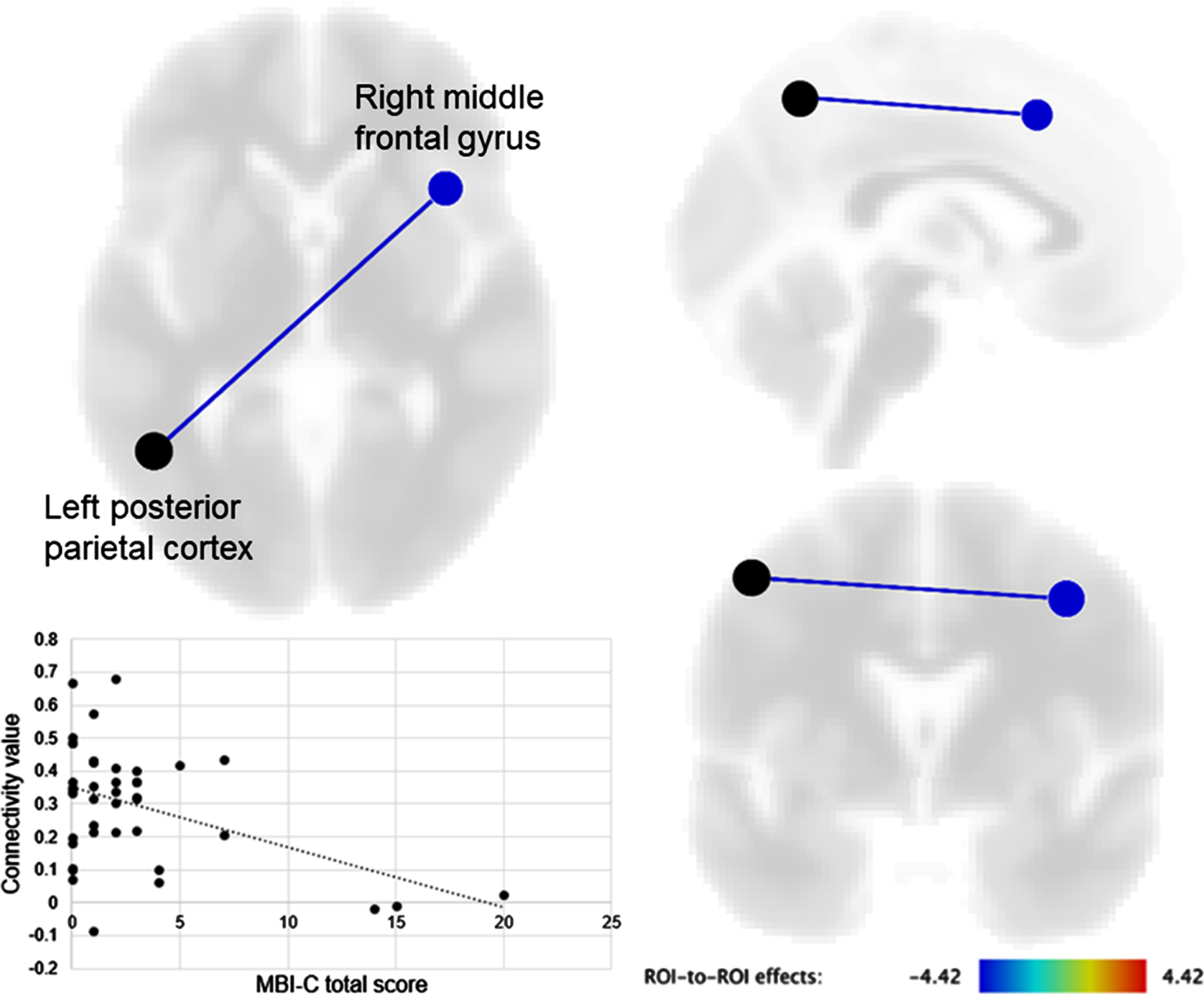 Brain regions showing a significant correlation of seed functional connectivity with the mild behavioral impairment checklist (MBI-C) total score. The connectivity value between the left posterior parietal cortex and right middle frontal gyrus was negatively correlated with the MBI-C total score.