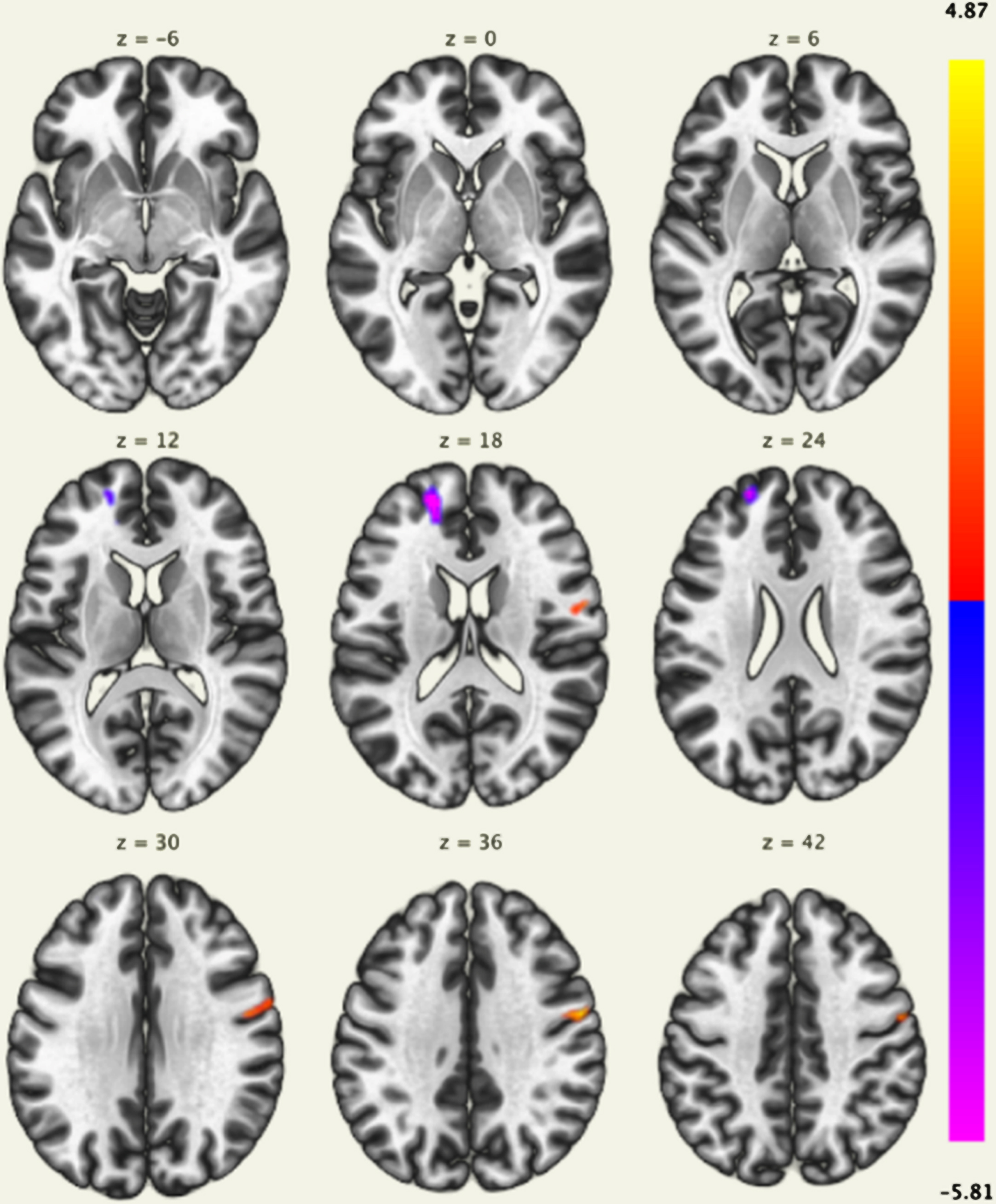 Brain regions with a significant positive correlation (red) and a significant negative correlation (blue) of voxel-based functional connectivity and the mild behavioral impairment checklist (MBI-C) total score. The left frontal pole and superior frontal gyrus were negatively correlated with the MBI-C total score, and the right precentral gyrus was positively correlated with the MBI-C total score.