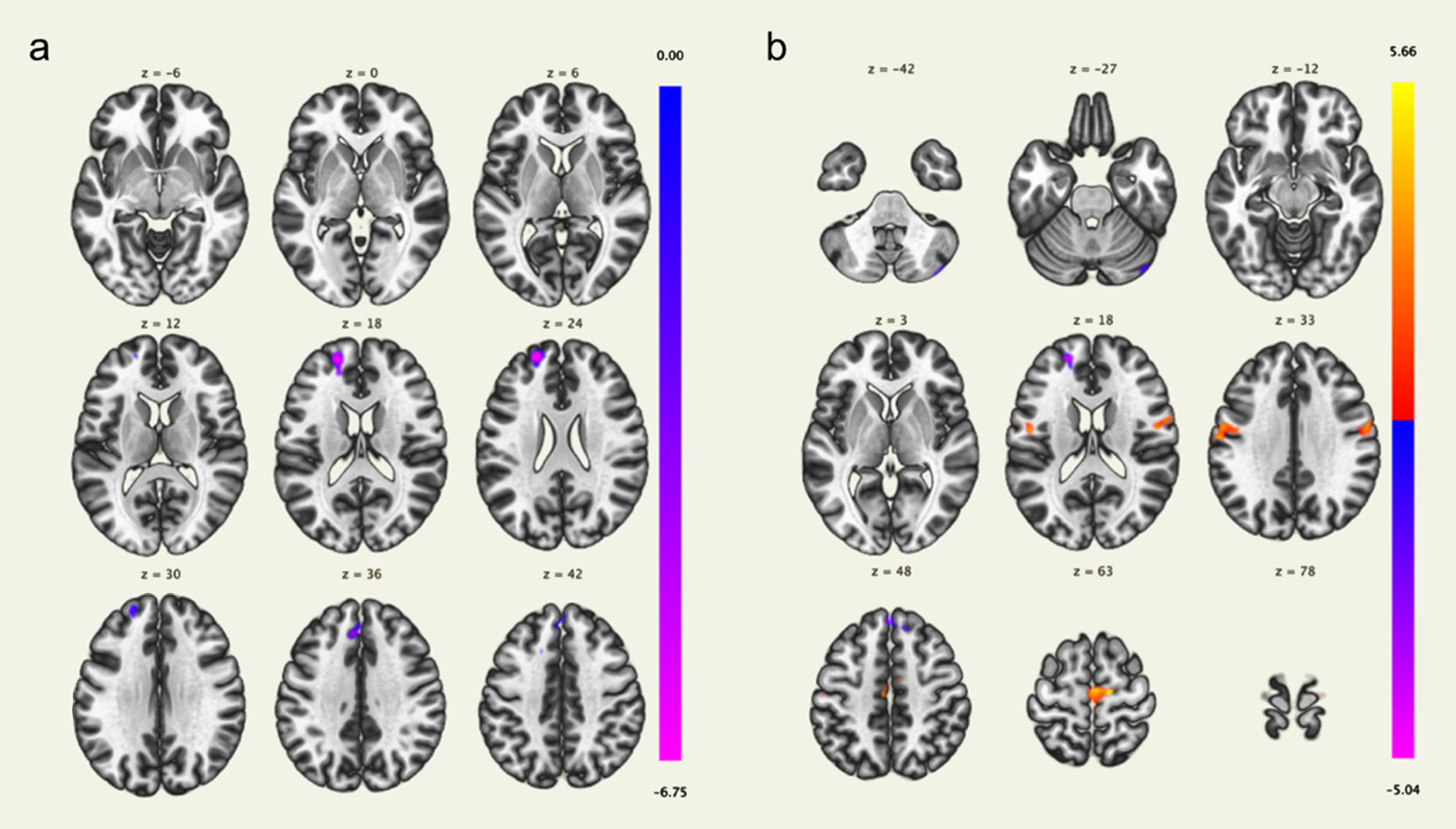 Brain regions with a significant positive correlation (red) and a significant negative correlation (blue) of voxel-based functional connectivity and the mild behavioral impairment checklist (MBI-C) affective dysregulation score (a) and impulse dyscontrol score (b). The left frontal pole and superior frontal gyrus were negatively correlated with the MBI-C affective dysregulation score (a). The bilateral precentral gyri were positively correlated with the MBI-C impulse dyscontrol score, and the left superior frontal gyrus, left frontal pole, and right cerebellum were negatively correlated with the MBI-C impulse dyscontrol score (b).