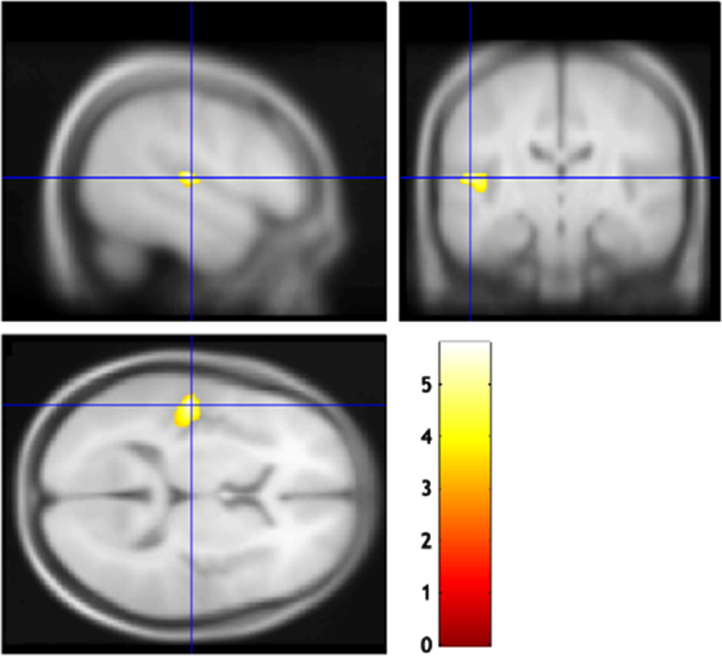 Brain regions correlated with the mild behavioral impairment checklist (MBI-C) impulse dyscontrol score. The gray matter volume of the left superior temporal gyrus was negatively correlated with the MBI-C impulse dyscontrol score.