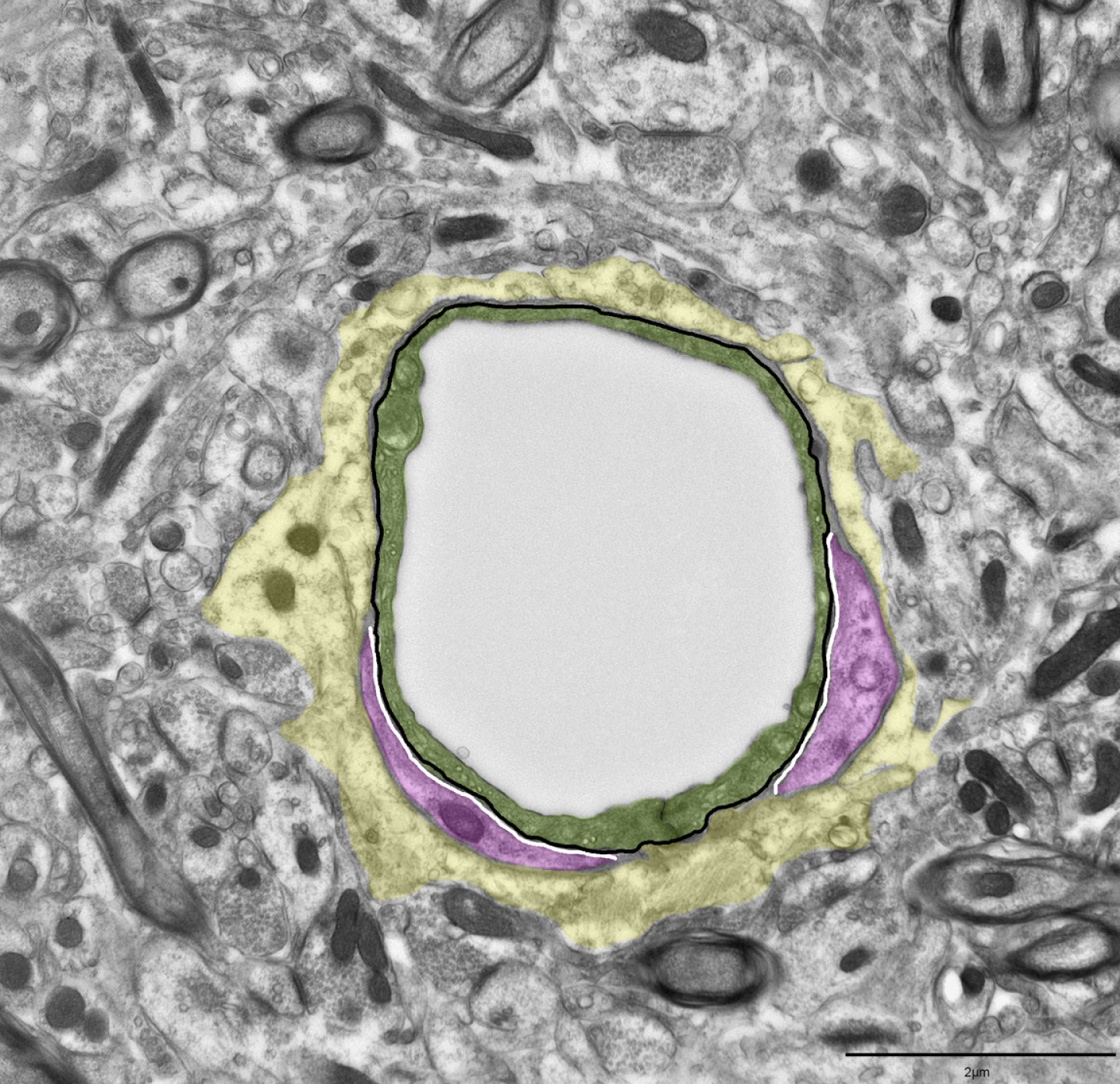 Procedure for quantification of pericyte coverage. Cross section of a capillary in cortex. Pericyte coverage was measured as the percentage of the endothelial cell perimeter covered by pericytes. The black line outlines the endothelial cell perimeter, and the white lines indicate endothelial cell membrane domains covered by a pericyte. Green overlay shows the endothelium and magenta identify pericytes while yellow outlines the astrocyte endfeet. Scale bar 2μm.