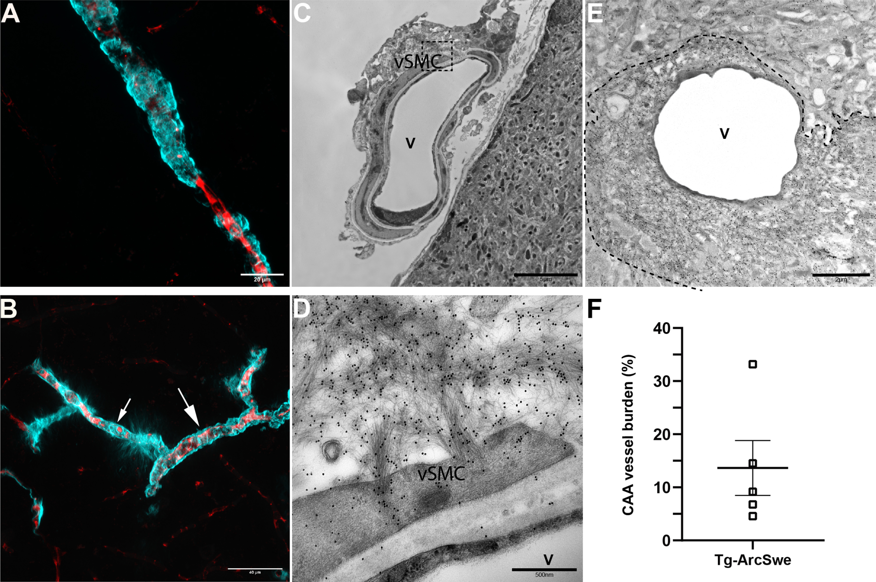 Aβ accumulates in leptomeningeal and penetrating arterioles and around capillaries in Tg-ArcSwe. A) Light microscopic image of a penetrating arteriole with CAA from the upper layer of cortex. Red, Texas red conjugated dextran; Cyan, Methoxy-X04. Scale bar 20μm. B) Light microscopic image of an arteriole (big arrow) and capillary (small arrow) in cerebral cortex in Tg-ArcSwe. The image demonstrates the difference in appearance of Aβ depositions. C) Electron micrograph of a leptomeningeal artery with Aβ accumulating in the vascular smooth muscle cells. Scale bar 5μm. D) Enlargement of marked area demonstrated in C. The image shows in detail how the Aβ fibrils deposits in the vSMCs. The Aβ fibrils are marked with immunogold histochemistry (black dots). Scale bar 500 nm. V, vessel; vSMC, vascular smooth muscle cell. E) An electron micrograph of a cortical capillary with Aβ accumulation marked with immunogold histochemistry. The dotted line marks the outer boundary of the Aβ fibrils. The fibrils are so densely packed near the endothelial cell making it difficult to define other cell types of the neurovascular unit. Scale bar 2μm. F) Quantitative assessment by unbiased stereology of CAA burden in cerebral cortex in 11–13-month-old Tg-ArcSwe animals demonstrated by area fraction. In these animals (n = 5) 13.66%±5.16% of the total vessels in cortex are affected by CAA. The data are presented as mean with SEM.