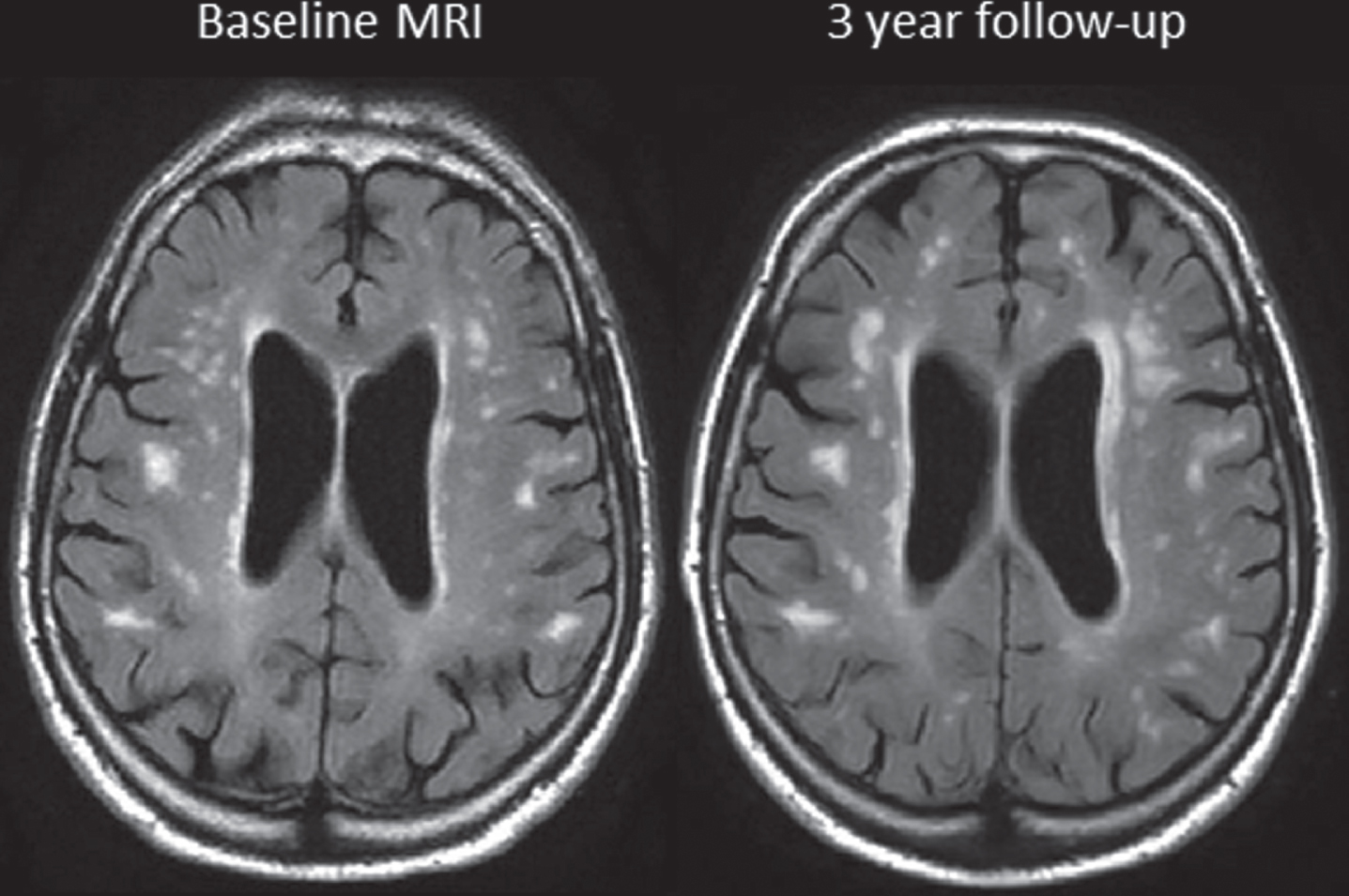 FLAIR MRI scans at baseline and 3 years in a CKD subject whose eGFR decreased from 38.1 to 34.8 units.