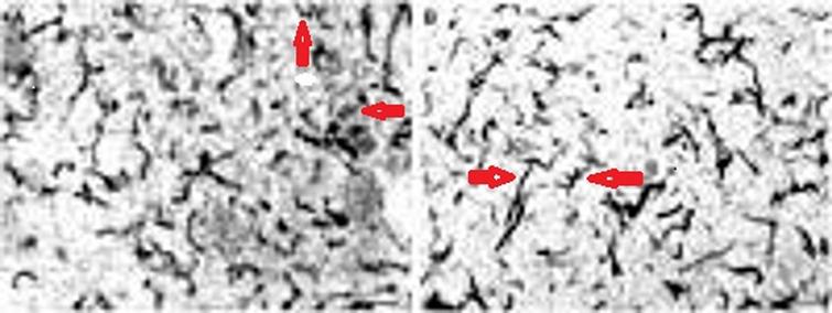 Brain tissue from GP (left) and AD (right); arrows show helical (coiled) nature of the spirochetes in each specimen. TP immunostain (L) and BB immunostain (R) 100X (from Miklossy et al. [14]).