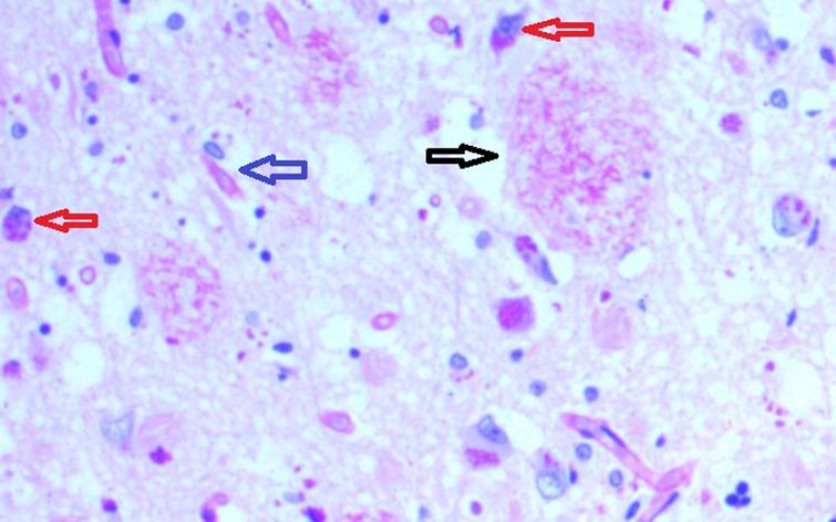 Hippocampal specimen from AD demonstrating extracellular biofilms (senile plaques-black arrow), intracellular biofilms (red arrows), neurofibrillary tangles with biofilm (blue arrow). PAS stain 40X.