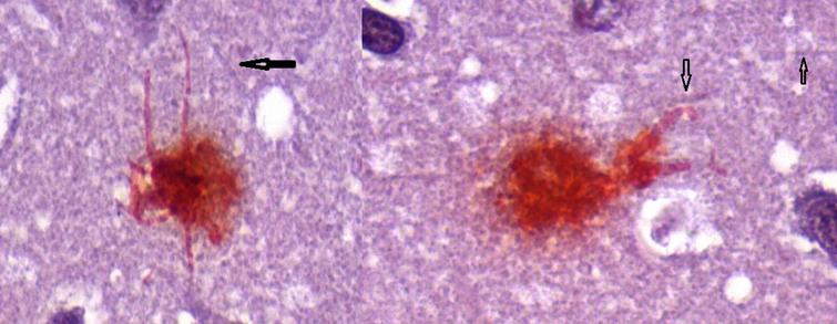 Neuron (L) containing intracellular biofilm (Congo red positive) with intact dendrites and Neuron (R) showing deformed, blunted dendrites. Arrows show uninvolved dendrites. Congo red 100X.