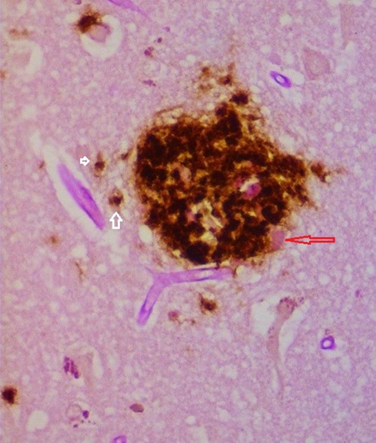 Senile plaque demonstrating biofilm (pink material red arrow) coated by Aβ. Intracellular Aβ noted in cells to the left of the plaque (white arrows). Combined PAS and Aβ immunostain 40X.