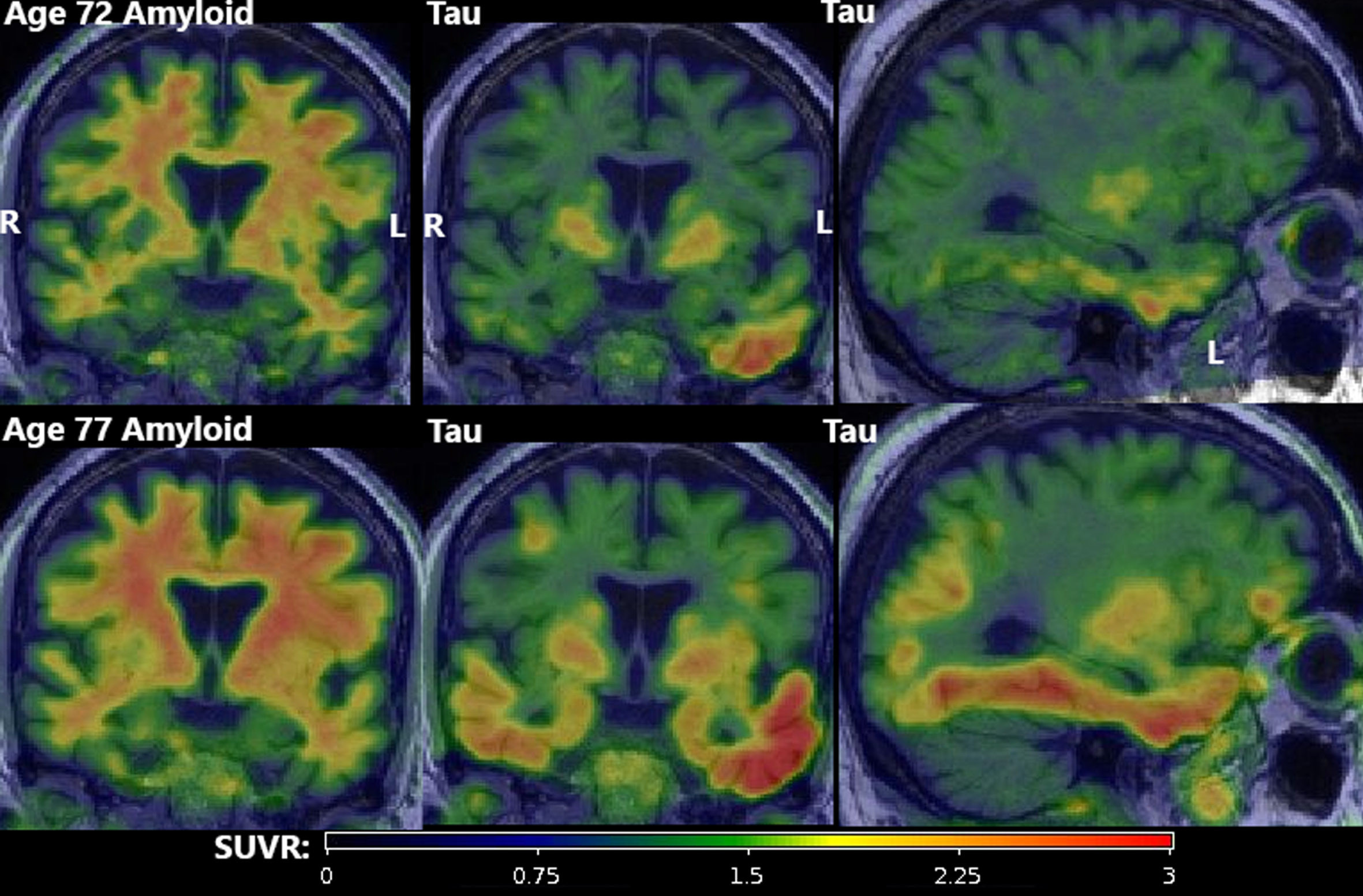 PET findings. Amyloid (first column; PiB) and tau PET (second two columns; Flortaucipir) at age 72 (top row) and age 77 (bottom row). All amyloid scans were visually negative (A–) despite quantitative elevation due to substantial but age-expected off-target binding in adjacent WM. Tau scans showed atypically high suprathreshold (T+) signal in an asymmetric (L > R) pattern primarily in the temporal lobe with focal uptake in the frontal, parietal, and occipital lobes. All scans were of good quality and all potential technical explanations for the atypically elevated signal (e.g., motion, attenuation correction error, misregistration) were excluded.