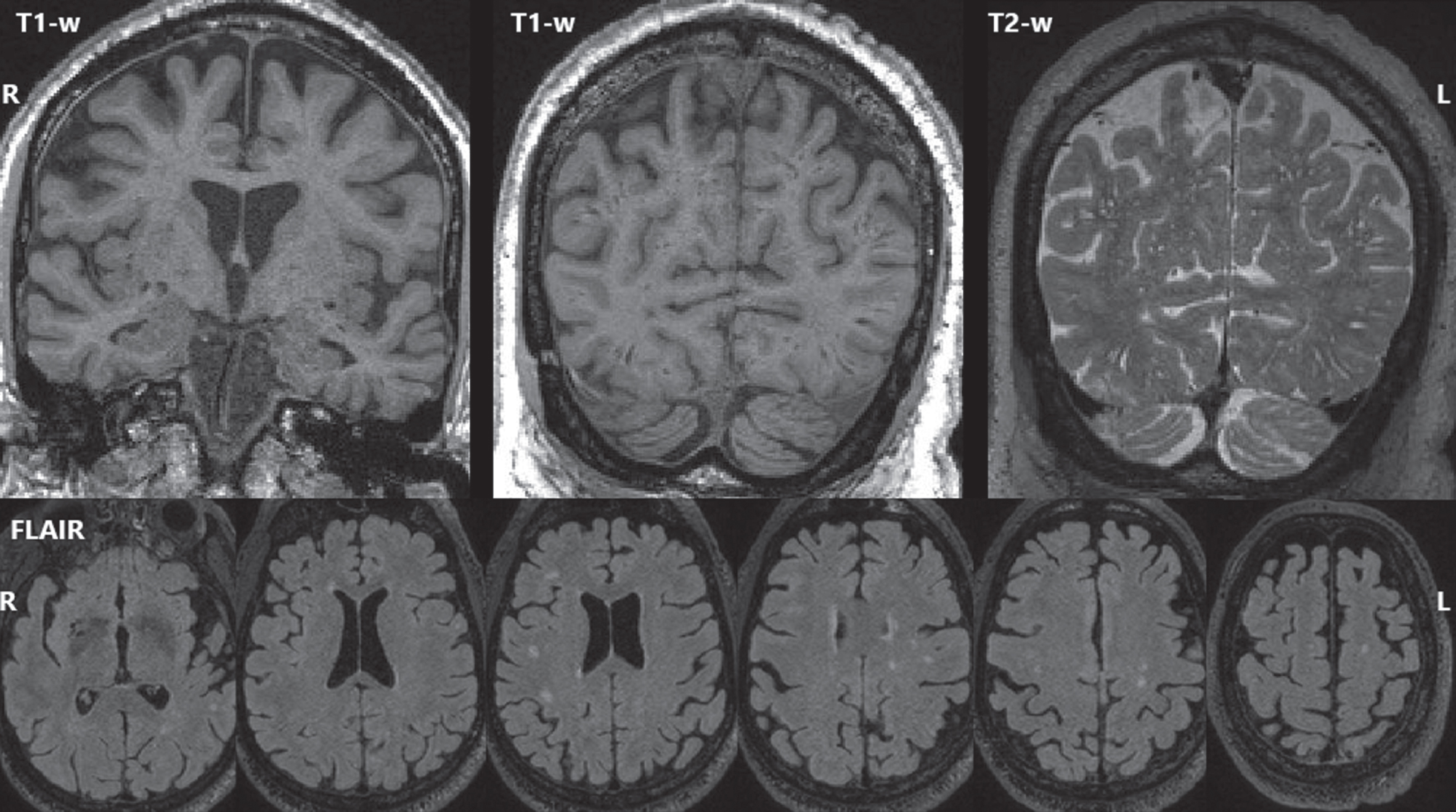 MRI findings. The most recent (age 77) T1-weighted MRI (top left, top center), and T2-weighted MRI (top right) showed mild global volume loss and extensive dilated perivascular spaces throughout the cerebrum. FLAIR MRI (bottom row) showed white matter hyperintensities (biomarkers of small vessel ischemic change) with an age-typical total volume but an atypical distribution with focal lesions scattered throughout deeper white matter rather than a more typical periventricular pattern.