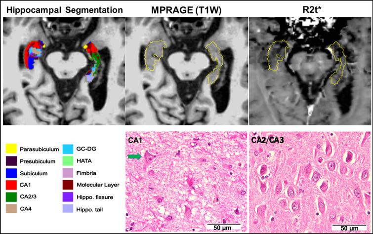 Data obtained from an 81-year-old male study participant with a clinical diagnosis of dementia (CDR 1) who underwent qGRE MRI 14 months prior to expiration (upper panel). qGRE R2t* in the hippocampus (outlined in yellow with hippocampal subfields shown in colors, segmented based on FreeSurfer) shows Dark Matter (hypointense lesions with lower R2t* values) in parts of subiculum, parasubiculum and CA1, indicating the loss of neurons. This is confirmed by direct neuropathological examination shown in the lower panel obtained from the postmortem studies from this participant. Severe neuronal loss in CA1 (hematoxylin and eosin stain) is reflected by the presence of only one remaining definitively identifiable neuron (indicated by the arrow) within this representative image; relative neuronal preservation is shown in a representative photomicrograph from CA2/CA3. Unlike qGRE R2t*, T1-weighted MPRAGE imaging finds the hippocampal region to be practically homogeneous without any obvious intensity contrast. Hence, the data demonstrate a higher sensitivity of qGRE R2t* measurements to tissue neuronal loss as compared with standard volumetric measurements. Scale bars are 50 micrometers.