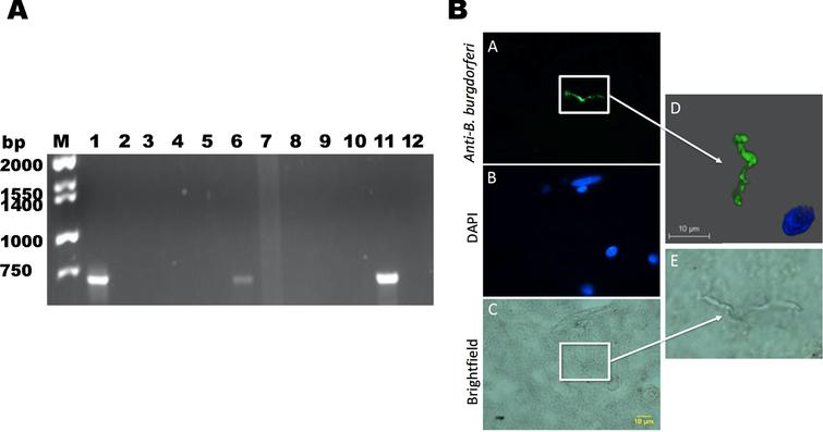 Analyses of potential presence of B. burgdorferi in patients diagnosed with neurodegenerative diseases. A) B. burgdorferi specific PCR detection. Bands at 706 bp indicate nested amplification of CTP synthase and the presence of B. burgdorferi DNA. A positive control consisting of B. burgdorferi B31 gDNA (lane 1) and a negative control with no DNA template were used (lane 2). Positive bands were observed in two AD patients (lane 6 and 11) indicating the presence of B. burgdorferi in these brain tissues. B) B. burgdorferi spirochete found in brain tissue section of PCR positive patient diagnosed with AD (lane 11). Panel A shows a positively stained Borrelia spirochete. D) The morphology of the spirochetal structure seen in panel A which was IHC positive for B. burgdorferi was further analyzed by confocal microscopy. Panel E shows the structure stained in panel A and C magnified. Panels A-C were imaged at 1000x magnification.