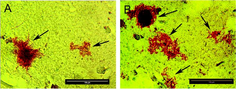 Representative images of Basic Fuchsin positive structures with evident spirochetal morphology (black arrows, red staining) in autopsy of cerebral cortex from the patient diagnosed with AD and Lyme disease. Magnification 400x, Size bars = 100 microns.