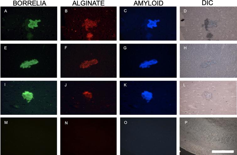 Representative immunofluorescence images of B. burgdorferi positive aggregates with amyloid co-localization in a human brain tissue section. Panels A, E, and I show IHC staining results for infected brain autopsy tissue using a FITC labeled anti-Borrelia antibody (green). White arrow shows a B. burgdorferi antigen positive spirochete. Panels B, F, and J show results using anti-alginate antibody (red). Panels C, G, and K show results with Aβ antibody (blue). Panels D, H, L, and P demonstrate tissue morphology with DIC microscopy. Panels N and O show experiments omitting primary antibodies, but secondary antibodies, as negative control. For Panel M, the FITC labeled anti-Borrelia antibody, an FITC labeled anti-rabbit antibody was used to mimic the green, fluorescent staining. All images were taken at 400x. The scale bar shows 200 micrometers.