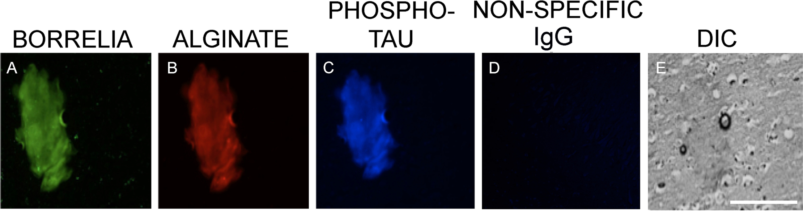 Representative images of a B. burgdorferi positive aggregate with phospho-tau co-localization in human brain tissue sections. Panel A shows IHC staining results for infected brain tissue using a FITC labeled anti-Borrelia antibody (green). Panel B shows results using anti-alginate antibody (red). Panel C shows staining with anti-phospho-tau antibody (blue). Panel D demonstrates non-specific IgG negative control and Panel E shows tissue morphology with DIC microscopy. All images were taken at 400x. The scale bar shows 200 micrometers.