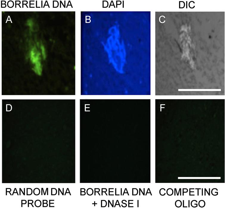 Fluorescence in situ hybridization confirmation of Borrelia burgdorferi biofilm-like aggregates in the patient brain tissue. Panel A shows result with Borrelia 16s rDNA probe. Panel B shows DAPI nuclear stain. Panel C demonstrates the tissue morphology by DIC microscopy. Panel D shows no staining from an unspecific random DNA probe to further prove the specificity of the Borrelia specific DNA probe. Panel E show result of a DNase pretreated tissue section before adding Borrelia DNA probe in the experiments. Panel F shows results of a competing oligo+DNA probe. All the images were taken at 400x. The scale bar shows 200 micrometers.