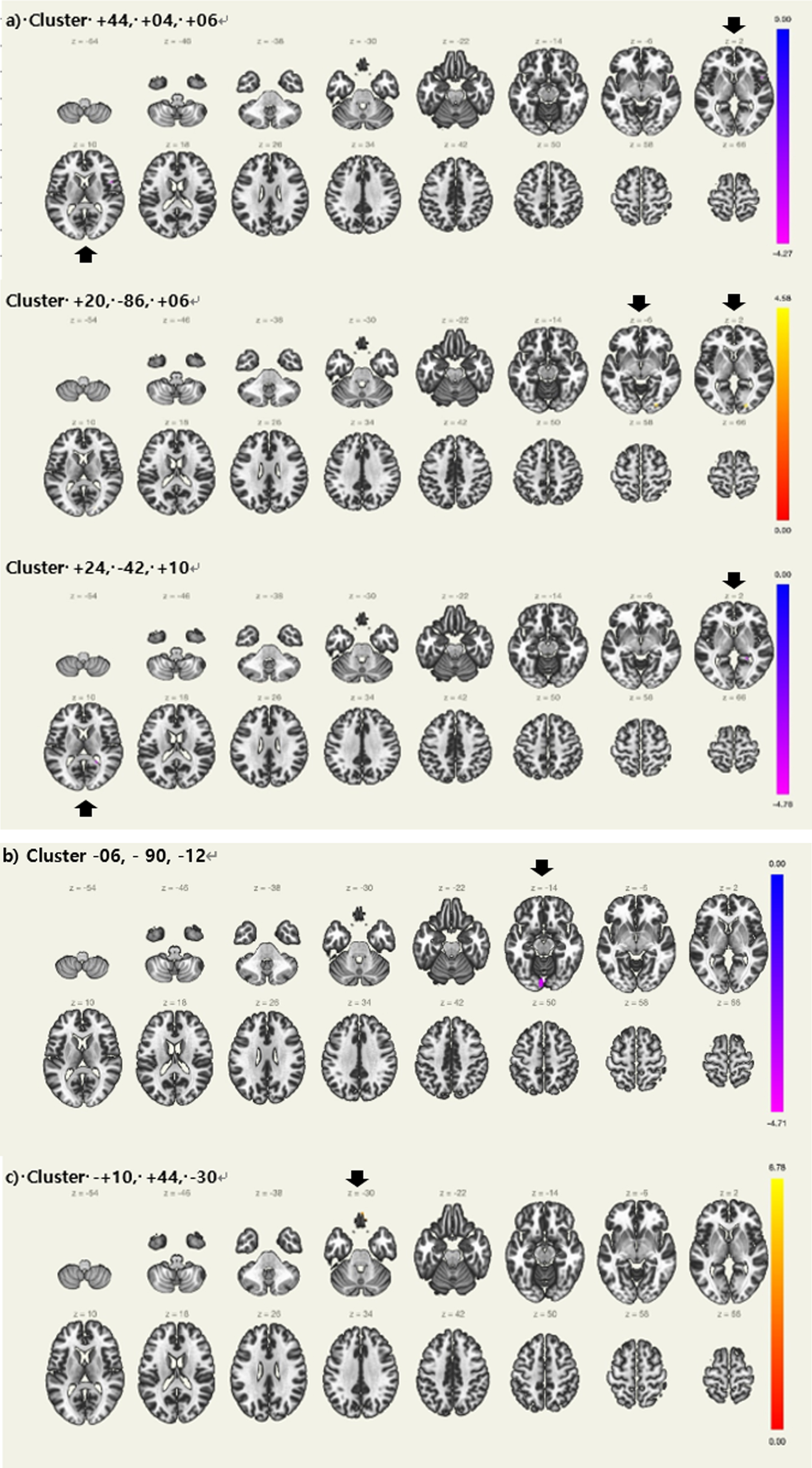 Regions with differences in resting state functional connectivity between Aβ+aMCI with prolonged sleep latency and normal sleep latency controlling for apolipoprotein ɛ4 carrier status a) Locus coeruleus. b) Left thalamus, c) Left hippocampus, Aβ+ aMCI = Amyloid positive amnestic mild cognitive impairment (Black arrows showing regions with significance).