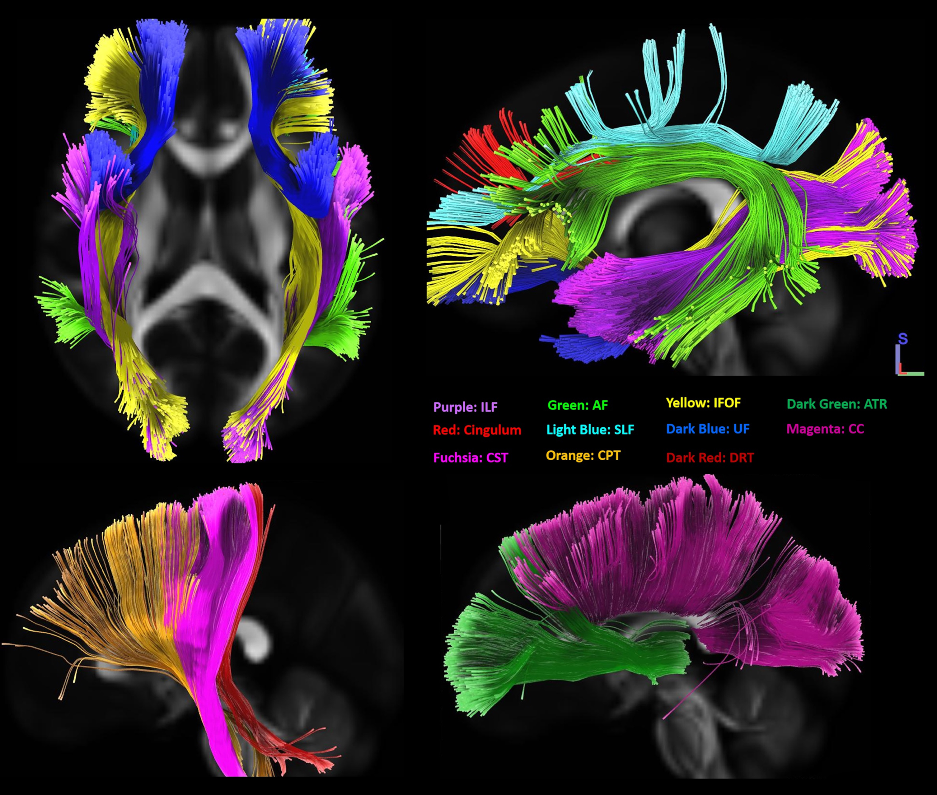 Overview of all significant white matter tracts from the correlational tractography models. ILF, inferior longitudinal fasciculus; AF, arcuate fasciculus; IFOF, inferior frontooccipital fasciculus; ATR, anterior thalamic radiation; SLF, superior longitudinal fasciculus; UF, uncinated fasciculus; CC, corpus callosum; CST, corticospinal tract; CPT, corticopontine tract; DRT, dentatorubrothalamic tract; RST, reticulospinal tract.