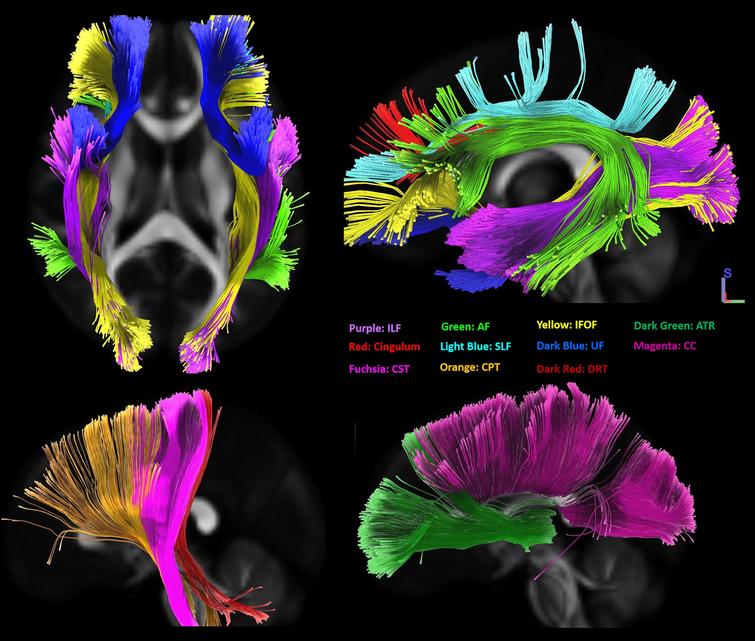 Overview of all significant white matter tracts from the correlational tractography models. ILF, inferior longitudinal fasciculus; AF, arcuate fasciculus; IFOF, inferior frontooccipital fasciculus; ATR, anterior thalamic radiation; SLF, superior longitudinal fasciculus; UF, uncinated fasciculus; CC, corpus callosum; CST, corticospinal tract; CPT, corticopontine tract; DRT, dentatorubrothalamic tract; RST, reticulospinal tract.