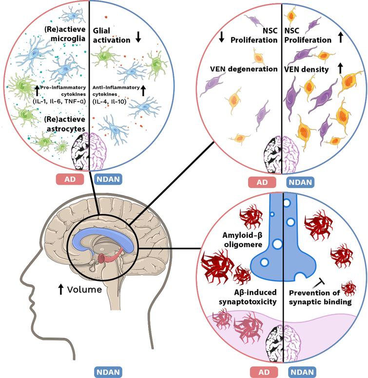 Mechanisms in NDAN and AD brain. Top left: Increase of (re)active microglia and astrocytes accompanied with elevated levels of pro-inflammatory cytokines (IL-1, IL-6, TNF-α) in AD. In NDAN brain glial activation is decreased and anti-inflammatory cytokine (IL-4, IL-10) levels are increased. Top right: In AD, proliferation of neural stem cells (NSCs) is decreased and ‘von Economo neurons’ (VENs) are degenerated, while in NDAN NSC proliferation is increased as well as VEN density. Bottom left: Volume of the hippocampus and corpus collosum is increased in NDAN. Bottom right: In AD, Aβ oligomers are able to bind the postsynaptic membrane and induce synaptotoxicity. In NDAN, binding of Aβ oligomers is prevented.
