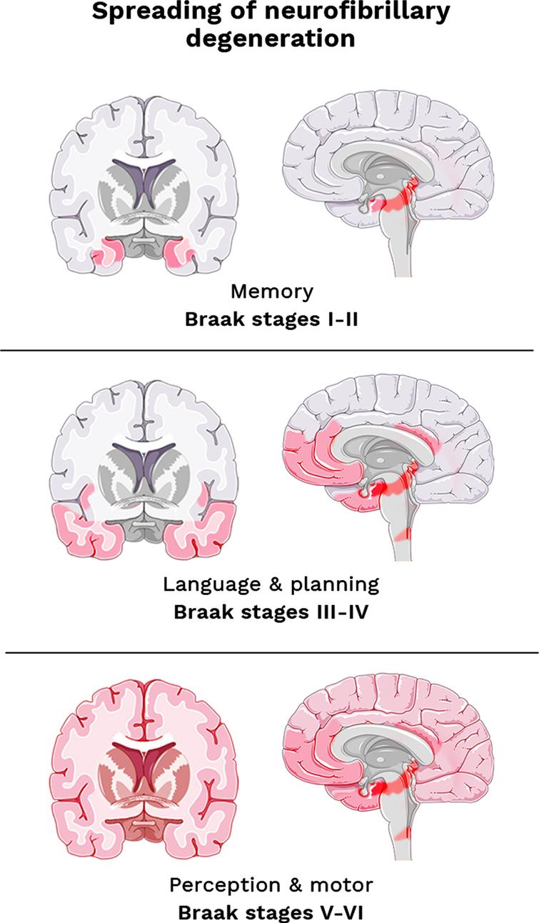 The Braak staging system adapted from Šimić et al. (2017) [84]. Topographic atrophic progression of AD caused by neurofibrillary degeneration. Initial memory loss correlates with hippocampal atrophy (stages I-II). Followed by disturbance in language & planning function, correlating with atrophy in the temporal, frontal, and parietal cortex (stages III-IV). And finally, impaired perception and movement, as associated with primary sensory and motor cortex (stage V-VI).