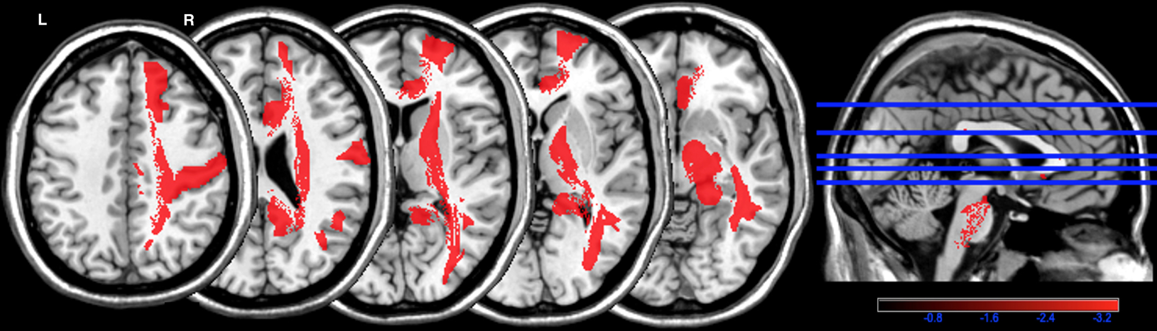 Parcel-based white matter hyperintensities symptom mapping (PWMHSM) analysis of structures associated with the G3 overall summary score. Color bar: z-score analysis of the strength of the association between white matter hyperintensities and the G3 overall summary score in structures of the Automatic Anatomical Labelling (AAL) and NatbrainLab (CAT) atlases (superior frontal region (mean z = –3.74), postcentral region (mean z = –3.71), cingulum (mean z = –3.56), cortico-spinal tract (mean z = –3.57), inferior longitudinal fasciculus (mean z = –3.62), internal capsule (mean z = –3.39), and posterior segment of the arcuate fasciculus (mean z = –3.41)). R, right; L, left.