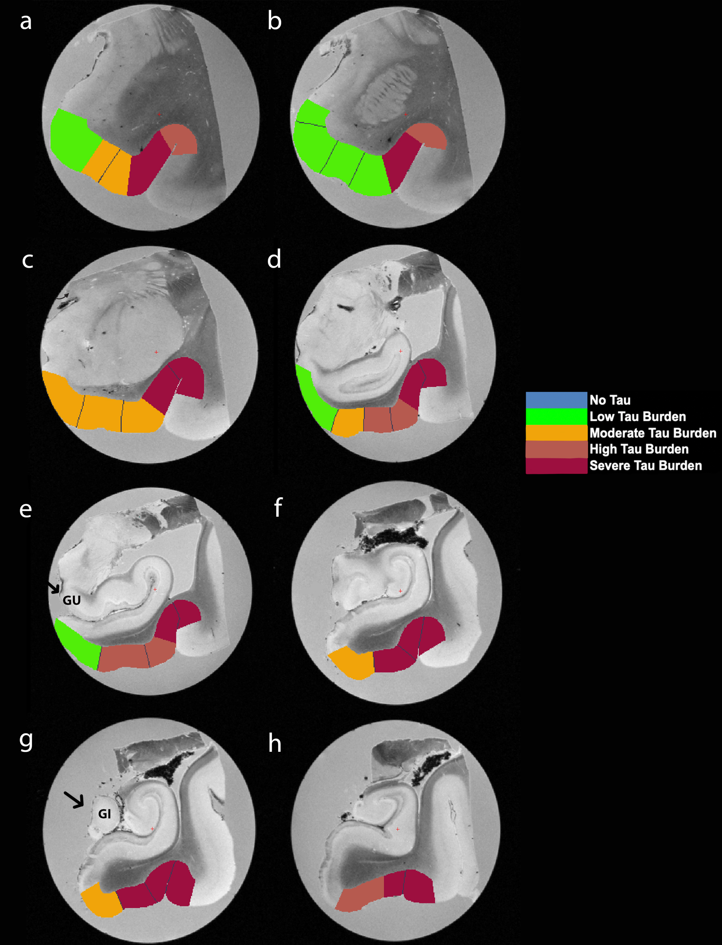 Manually Labeled Ex Vivo MRI: Semi-quantitative tau burden scores manually labeled on eight anterior-posterior levels (panels a-h) of a single case (case 6, Braak and Braak II). Labeled colors reflect corresponding semi-quantitative tau burden scores from Fig. 4. Blue labeling (score 0) means no CP13 tau pathology, no NFTs, no NTs. Green labeling (score 1) means very low tau/NFT burden and essentially isolated tangles in this region. Note that the green labels were restricted to medial and anterior subregions. Orange (score 2) conveys a moderate tau burden both in number of NFTs and NFT packing density. Rust (score 3) translated to a high tau burden and showed more densely packed and strongly stained NFTs and pretangles with substantial NTs. Burgundy (score 4) showed the greatest density for phosphorylated tau at CP13, with a large number of closely packed, immunostained NFTs and NTs blanketing most of the area. Black arrows point to the gyrus uncinatus (e) and the gyrus intralimbicus (g).