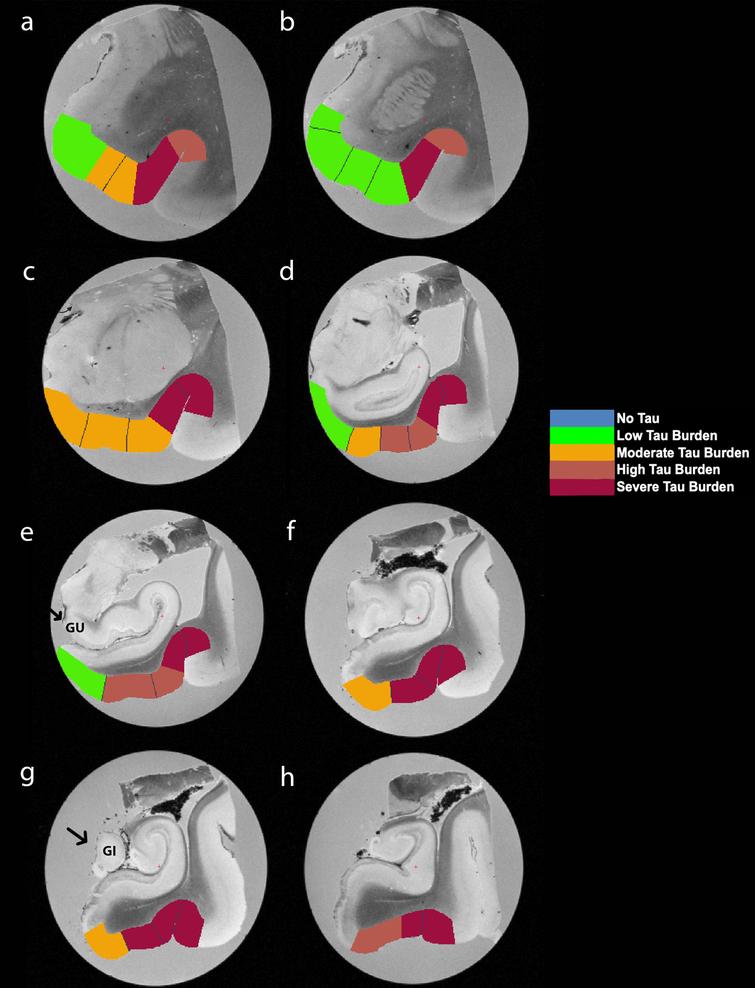 Manually Labeled Ex Vivo MRI: Semi-quantitative tau burden scores manually labeled on eight anterior-posterior levels (panels a-h) of a single case (case 6, Braak and Braak II). Labeled colors reflect corresponding semi-quantitative tau burden scores from Fig. 4. Blue labeling (score 0) means no CP13 tau pathology, no NFTs, no NTs. Green labeling (score 1) means very low tau/NFT burden and essentially isolated tangles in this region. Note that the green labels were restricted to medial and anterior subregions. Orange (score 2) conveys a moderate tau burden both in number of NFTs and NFT packing density. Rust (score 3) translated to a high tau burden and showed more densely packed and strongly stained NFTs and pretangles with substantial NTs. Burgundy (score 4) showed the greatest density for phosphorylated tau at CP13, with a large number of closely packed, immunostained NFTs and NTs blanketing most of the area. Black arrows point to the gyrus uncinatus (e) and the gyrus intralimbicus (g).