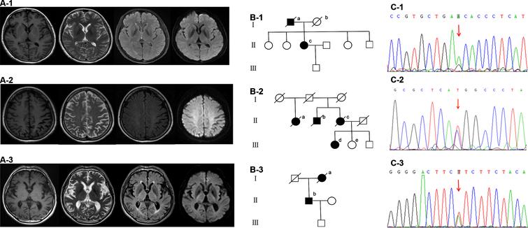 Brain MRI (A1-3), family diagram (B1-3) and Sanger validation of next-Generation sequencing variants (C1-3) in the three subjects harboring functionally validated PSEN2 pathogenic mutations. A-1, B-1, and C-1 are from case 1 with PSEN2 p.N141S (c.422A > G). Brain MRI is almost normal. On family diagram (B-1), II-c is the index patient. Her father (I-a) started with memory deficit in his 60s and died about a decade later. Her mother (I-b) died in her 70s without cognitive decline. Her three sisters and one brother are all cognitively normal. A-2, B-2, and C-2 are from case 2 with PSEN2 p.M239T (c.716T > C). Brain MRI shows left predominant parietal atrophy. On family diagram (B-2), III-d is the index patient. Her 46-year-old sister (III-e) and 39-year-old brother are cognitively normal. Her cousins are all over 50 years old without cognitive impairment. III-e receives gene sequencing which shows no PSEN2 p.M239T (c.716T > C) mutation. Her mother (II-c), uncle (II-b) and aunt (II-a) all showed cognitive deficit in their 70s and died around 80. The first generation had no cognitive decline when they were alive. However, their age of death was not clear. A-3, B-3, and C-3 are from case 3 with PSEN2 p.I368F (c.1102A > T). Brain MRI is almost normal. On family diagram (B-3), II-b is the index patient. Her mother (I-a) started with memory impairment in her 70s and died two years later.