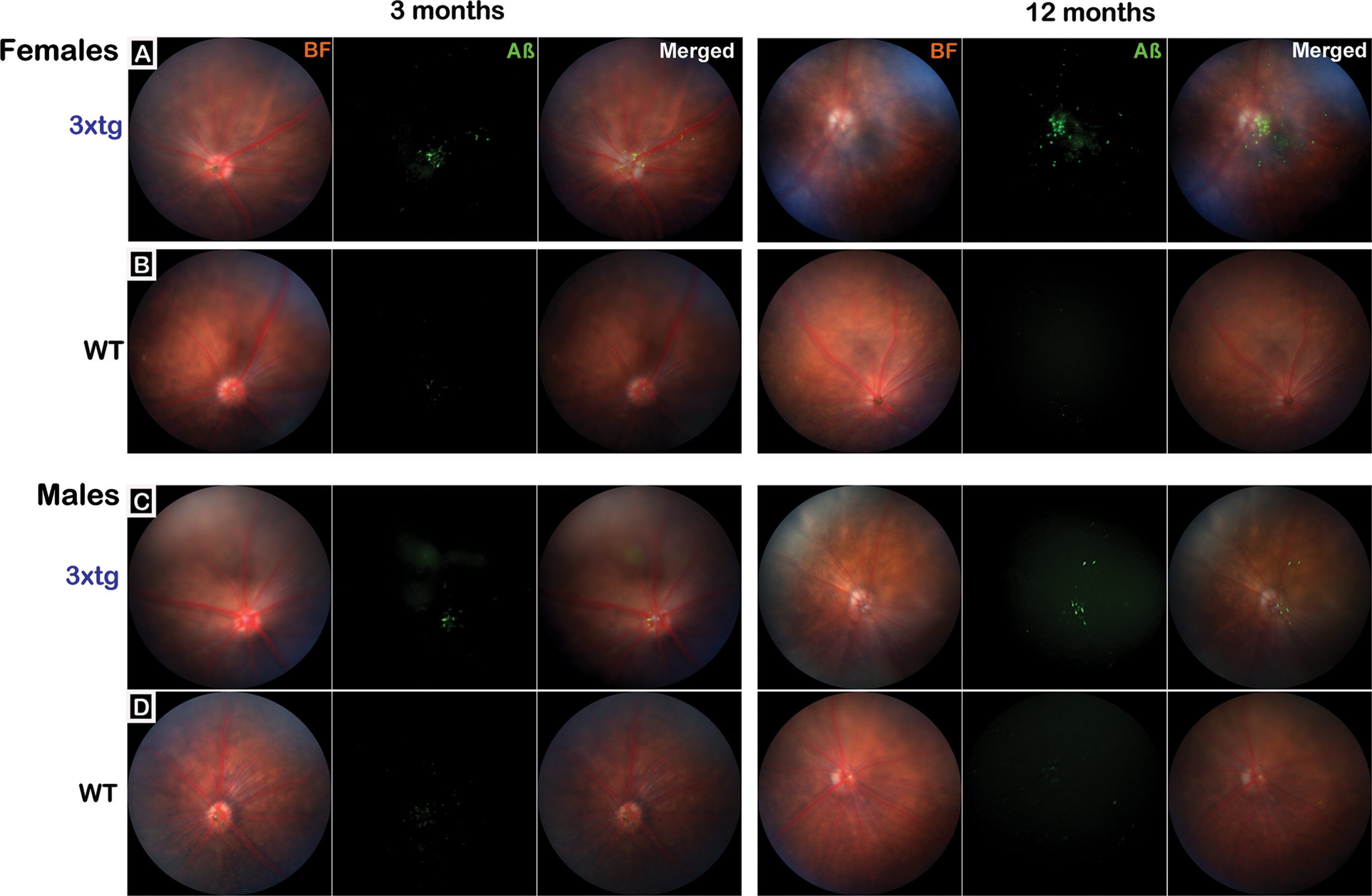 Visualization of retinal amyloid-β in 3xTg mice with in vivo ophthalmic imaging. The Micron IV ophthalmoscope was used to obtain representative retinal fundus images for baseline/early pathological stage (3 months) and pervasive pathological stage (12 months) 3xTg (rows A&C; n = 20 mice total; 10 mice/group) and age-matched wildtype (WT) C57BL/6J control mice (rows B&D; n = 20 mice total; 10 mice/group). Representative images from female (A&B) and male (C&D) mice from each genotype are presented. Brightfield (BF) images show retinal vasculature and optic disk; fluorescence (Aβ) images show signal detected after intravitreal injection of an AlexFluor-488 conjugated antibody that bound to retinal Aβ. Merged images overlay BF + Aβ. Images show that Aβ signal is detectable in 3xTg mice at 3 months of age but is more pronounced at 12 months (rows A&C). While present in both sexes, Aβ signal appears more abundant in female 3xTg mice. In merged images, Aβ can be seen distributed largely around the optic disc and vasculature with additional deposits in the periphery. No Aβ signal above background was detected in wildtype mouse retina (rows B&D).