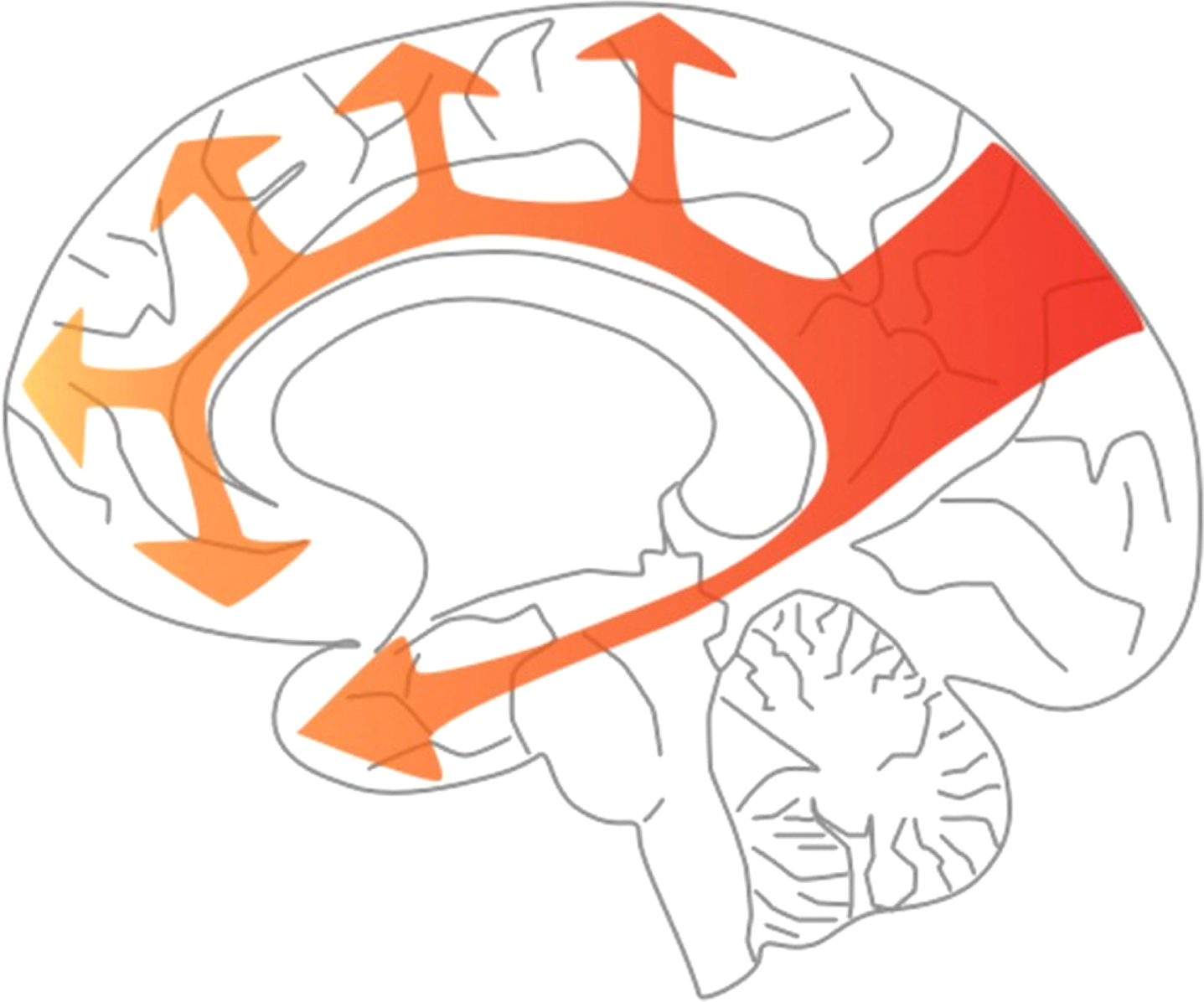 Stereotyped pattern of spread of hypoperfusion in AD. The arrows in this diagram indicate the progression of hypoperfusion, starting from the precuneus, well before the onset of dementia, and spreading to the rest of the parietal cortex and the cingulate gyrus, then the frontal and temporal cortex, largely sparing the occipital cortex until late disease. (This figure was originally published by Love et al. [18] and is distributed under the terms of the Creative Commons Attribution 4.0 International License (https://creativecommons.org/licenses/by/4.0/"). The figure was not modified.)
