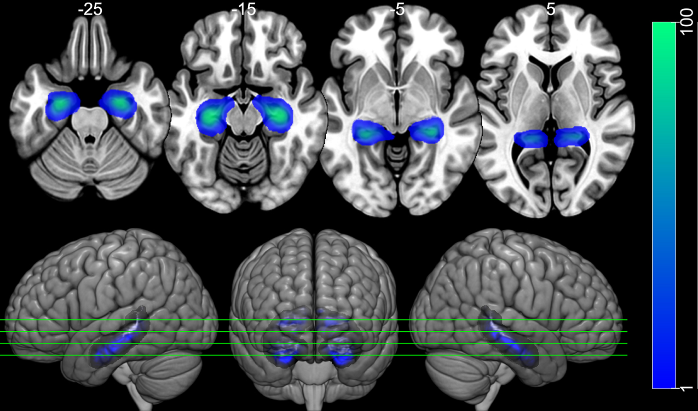 Hippocampal ROIs. Image of the left and right hippocampus ROIs over the MNI152 template. The ROIs were taken from the Harvard-Oxford Cortical Atlas. The ROIs have weights according to the probability of voxel belonging to the left or to the right hippocampus (left Blue-Green color scale). The top row shows 4 axial slides, taken from the positions indicated in the bottom row, which present 3D rendered images. Images are displayed following neurological convention.